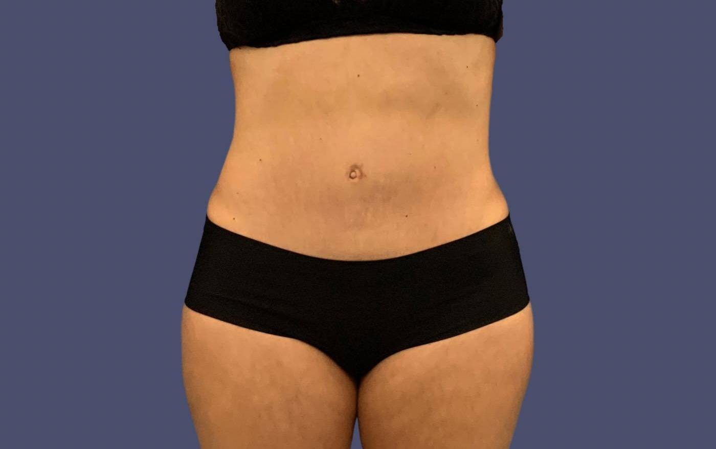 Abdominoplasty (Tummy Tuck) 4 After