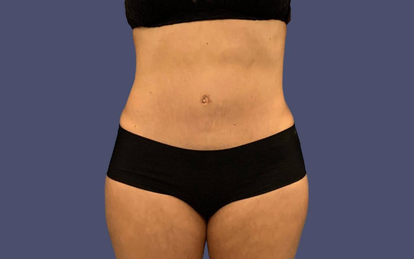 Abdominoplasty (Tummy Tuck) 5 After