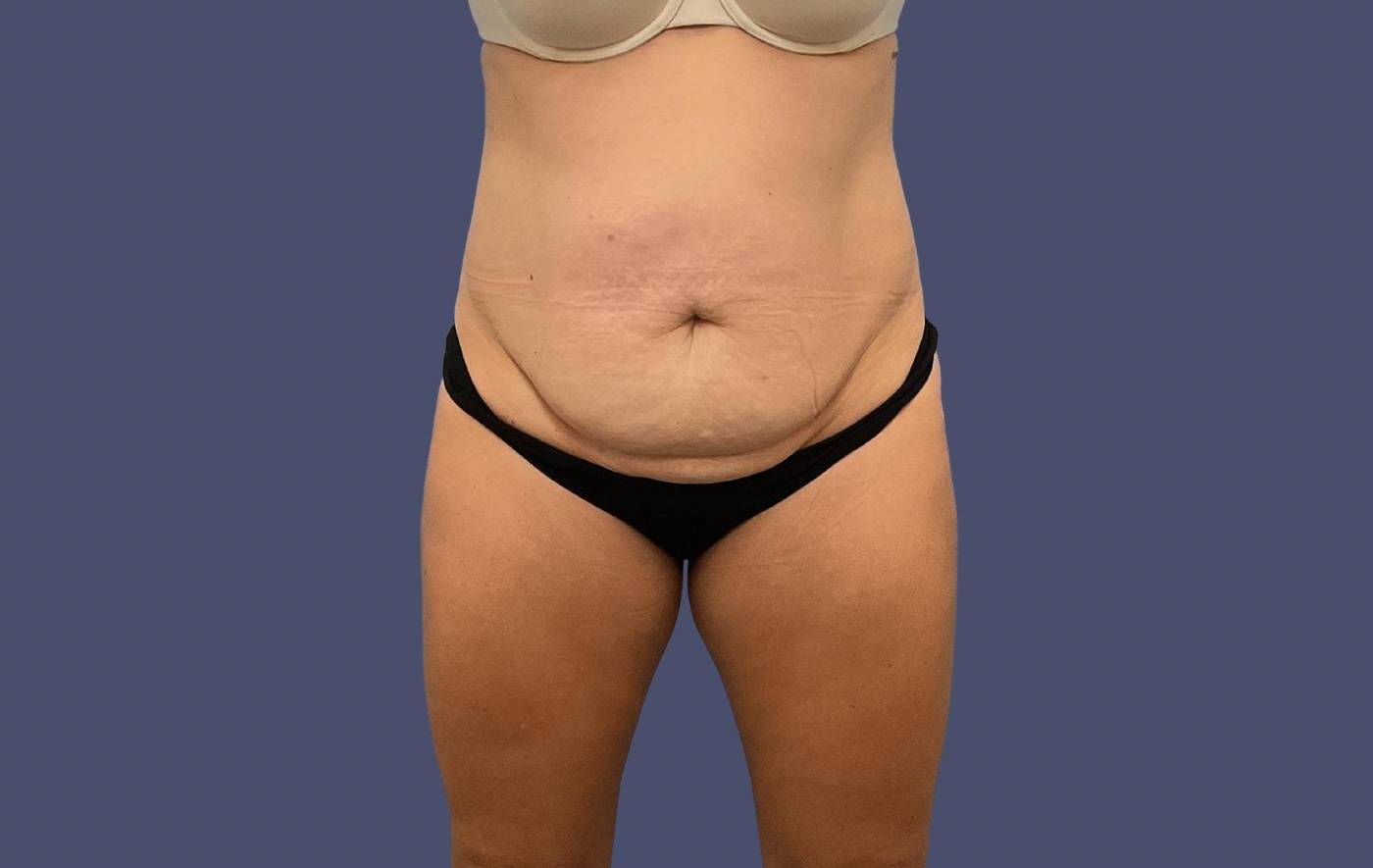 Abdominoplasty (Tummy Tuck) 20 Before
