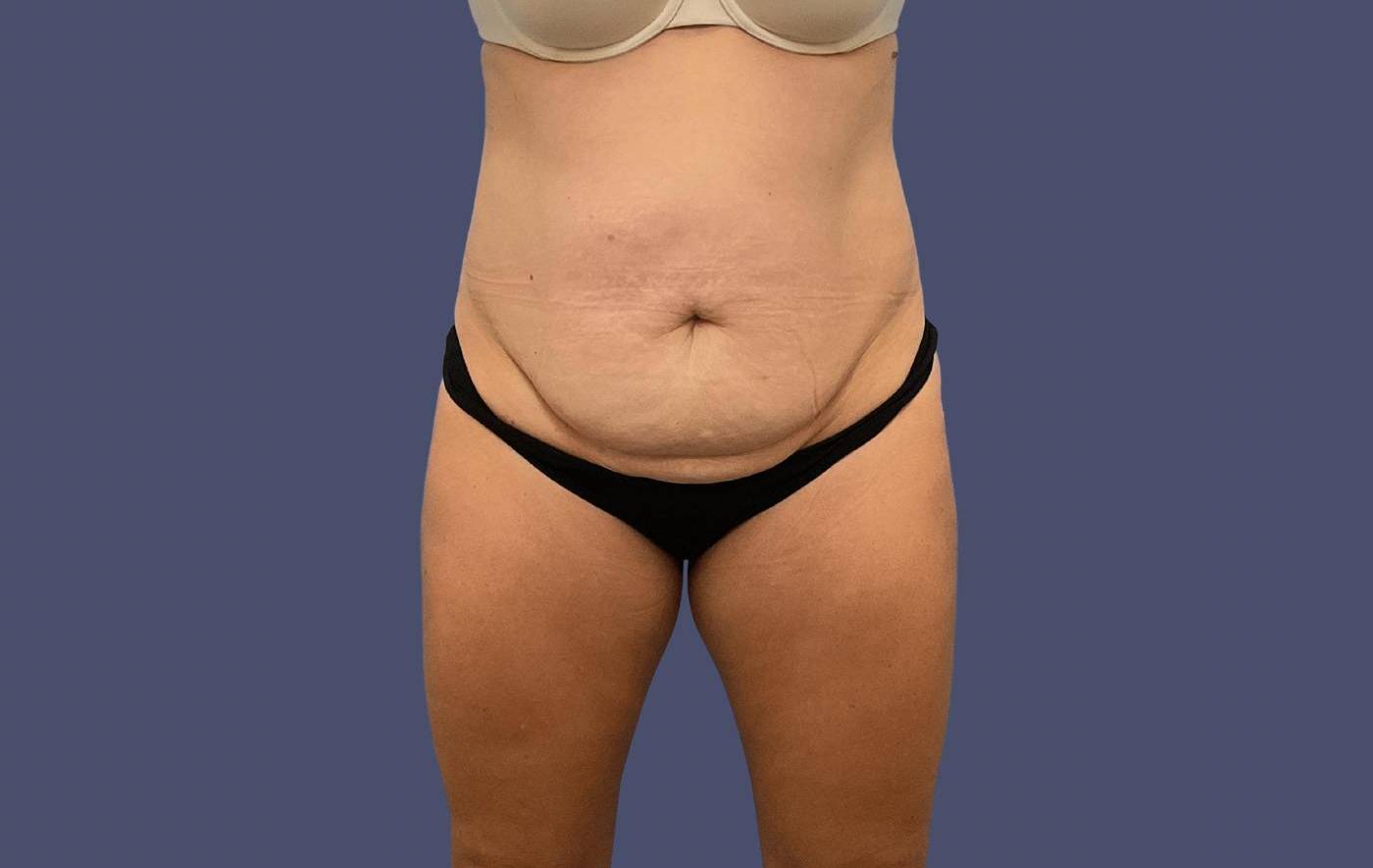 Abdominoplasty (Tummy Tuck) 22 Before