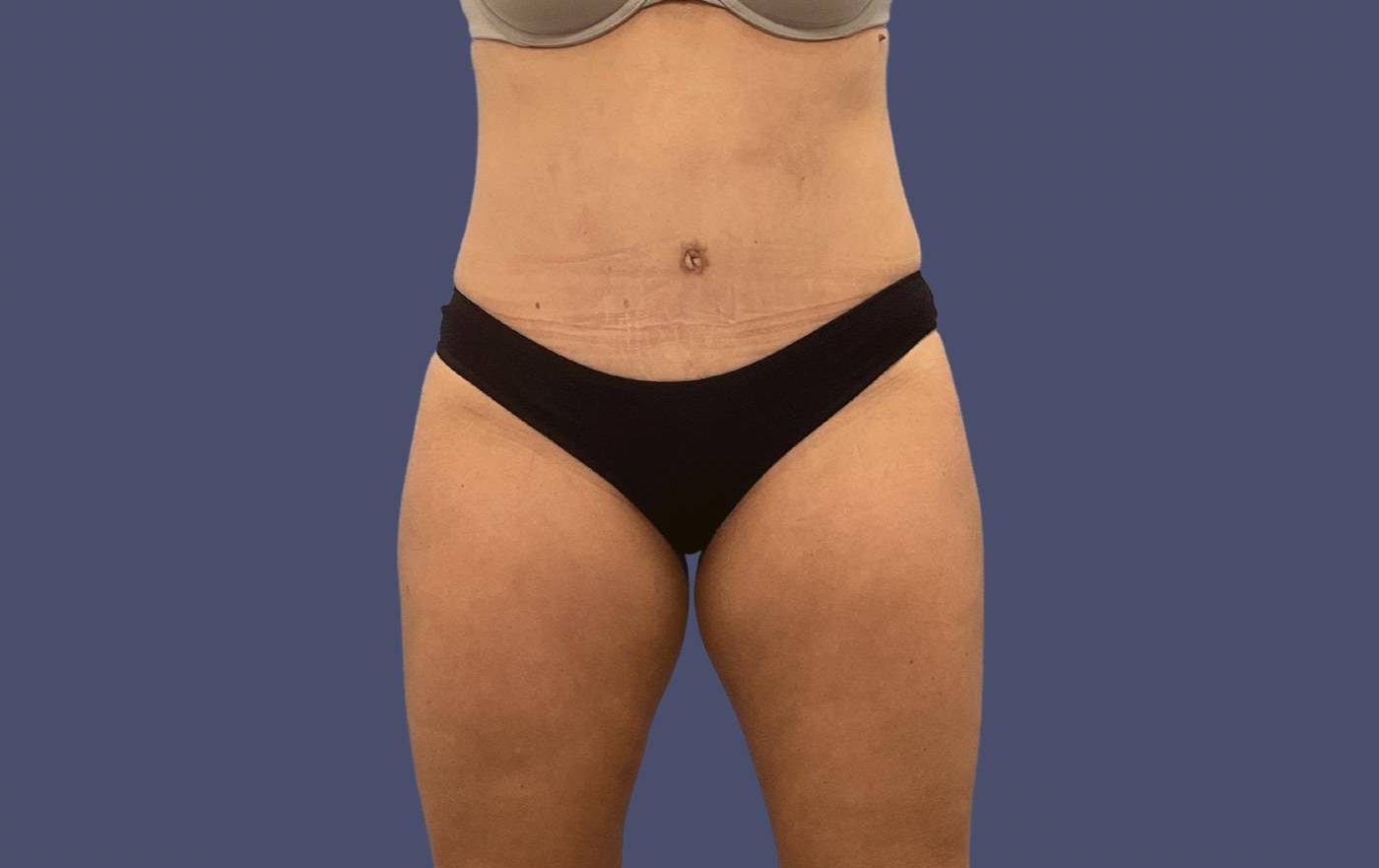 Abdominoplasty (Tummy Tuck) 20 After