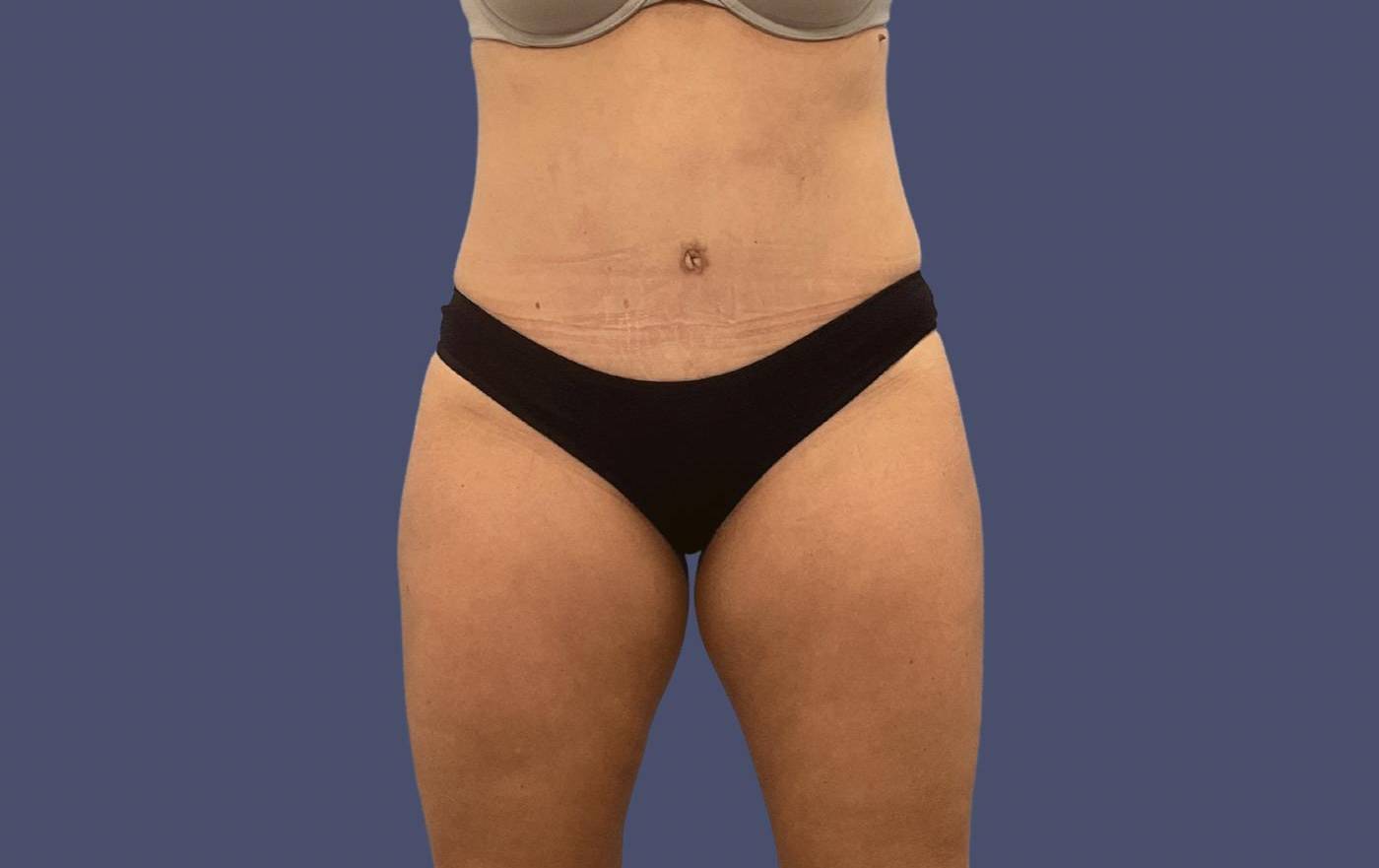 Abdominoplasty (Tummy Tuck) 22 After