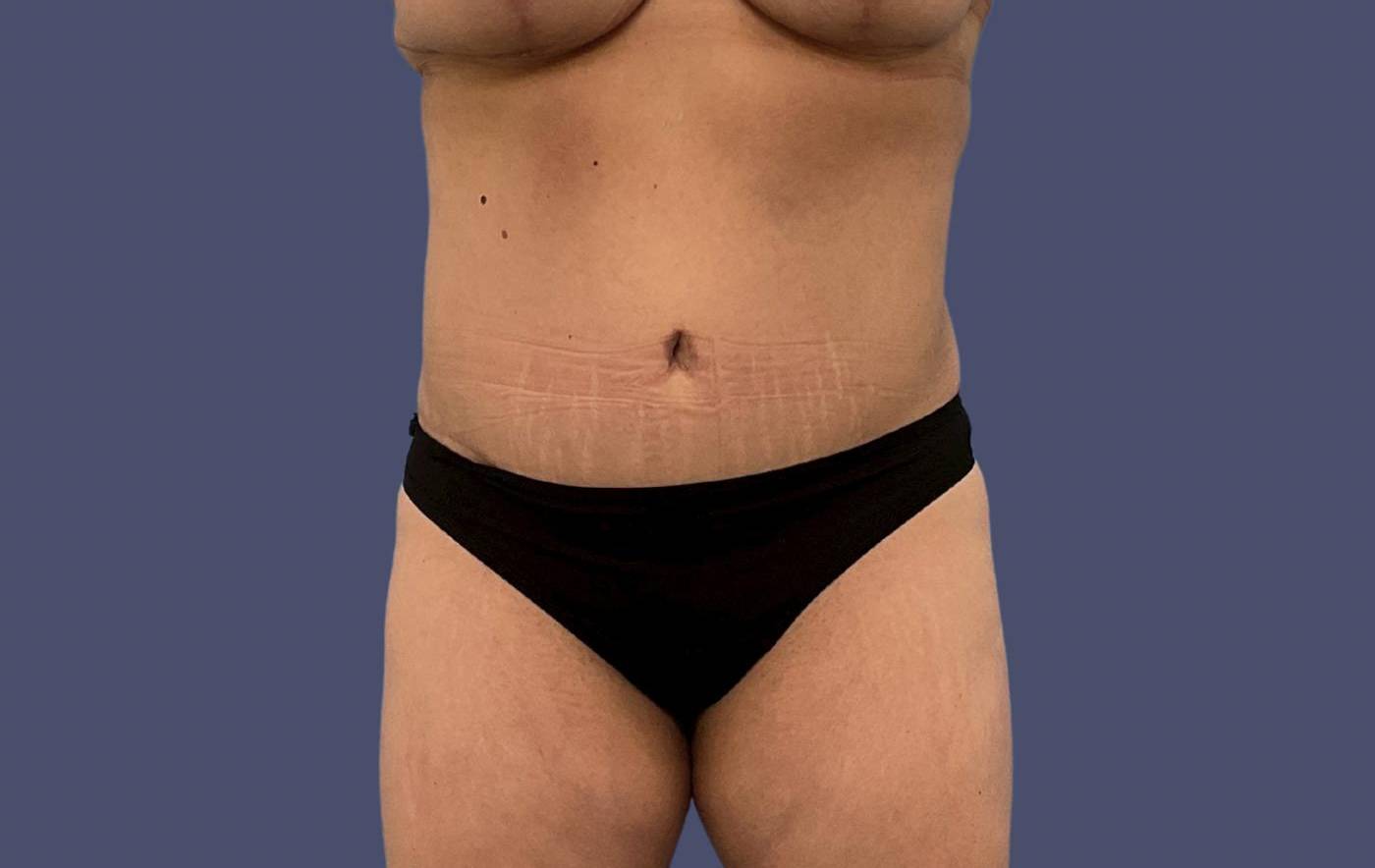 Abdominoplasty (Tummy Tuck) 19 After