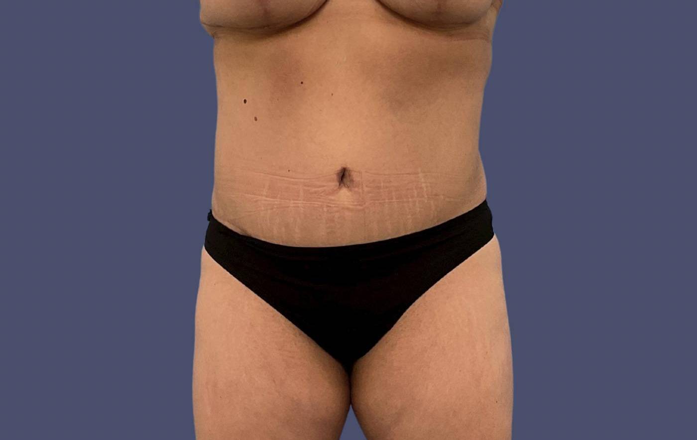 Abdominoplasty (Tummy Tuck) 21 After