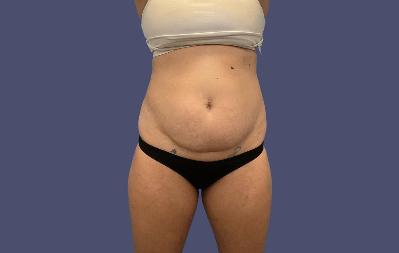 Abdominoplasty (Tummy Tuck) 24 Before