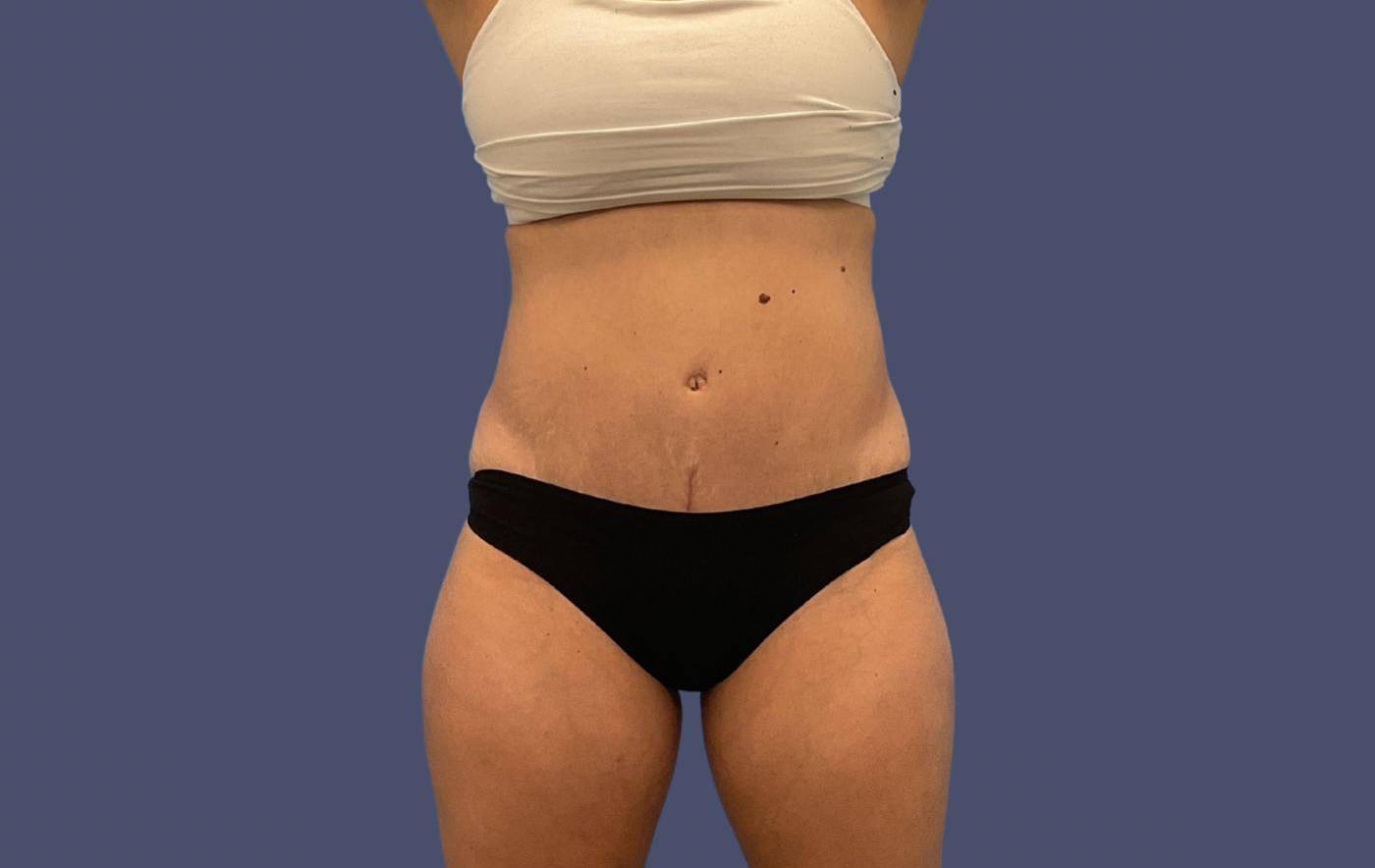 Abdominoplasty (Tummy Tuck) 24 After