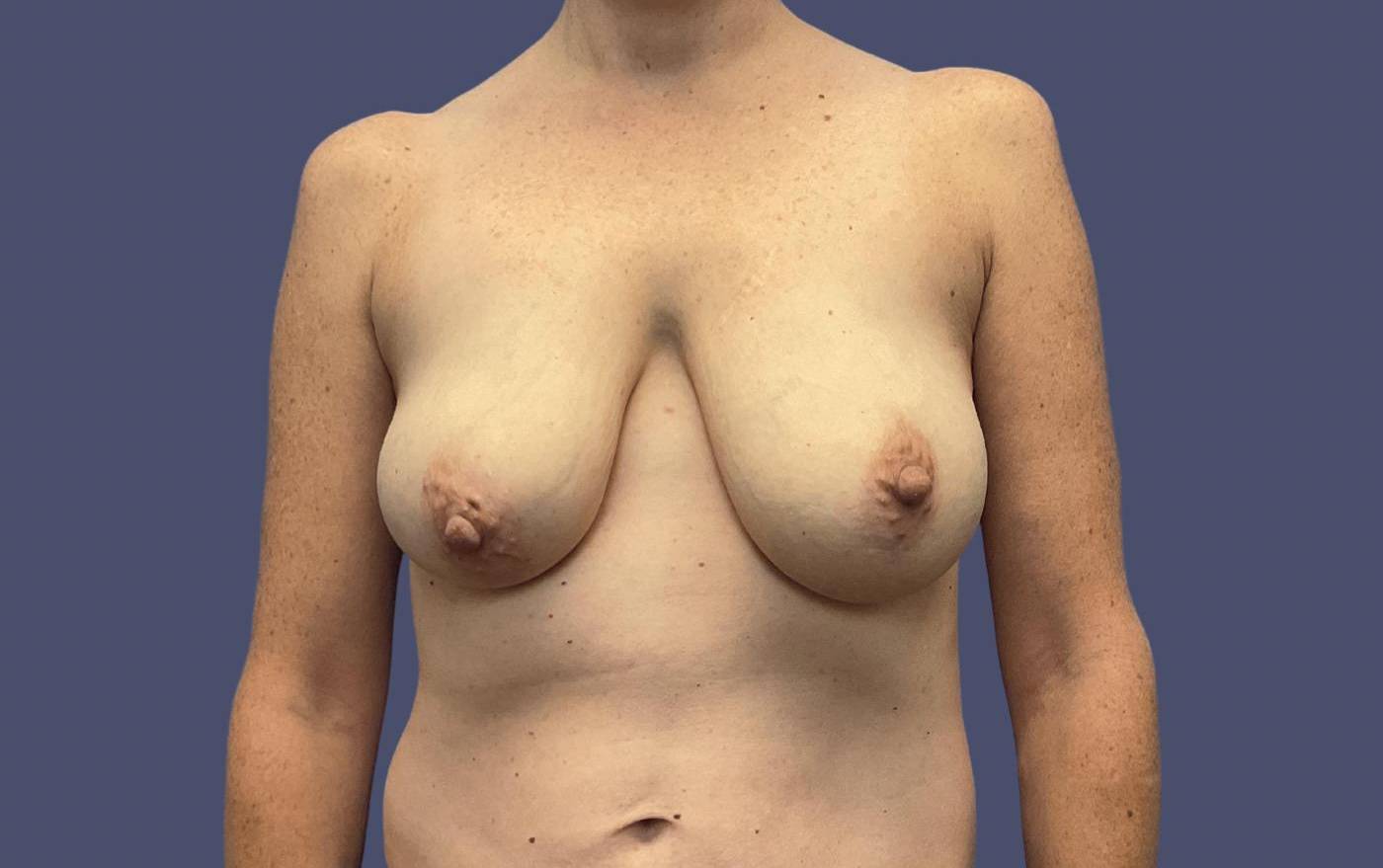 Breast Reduction 9 Before