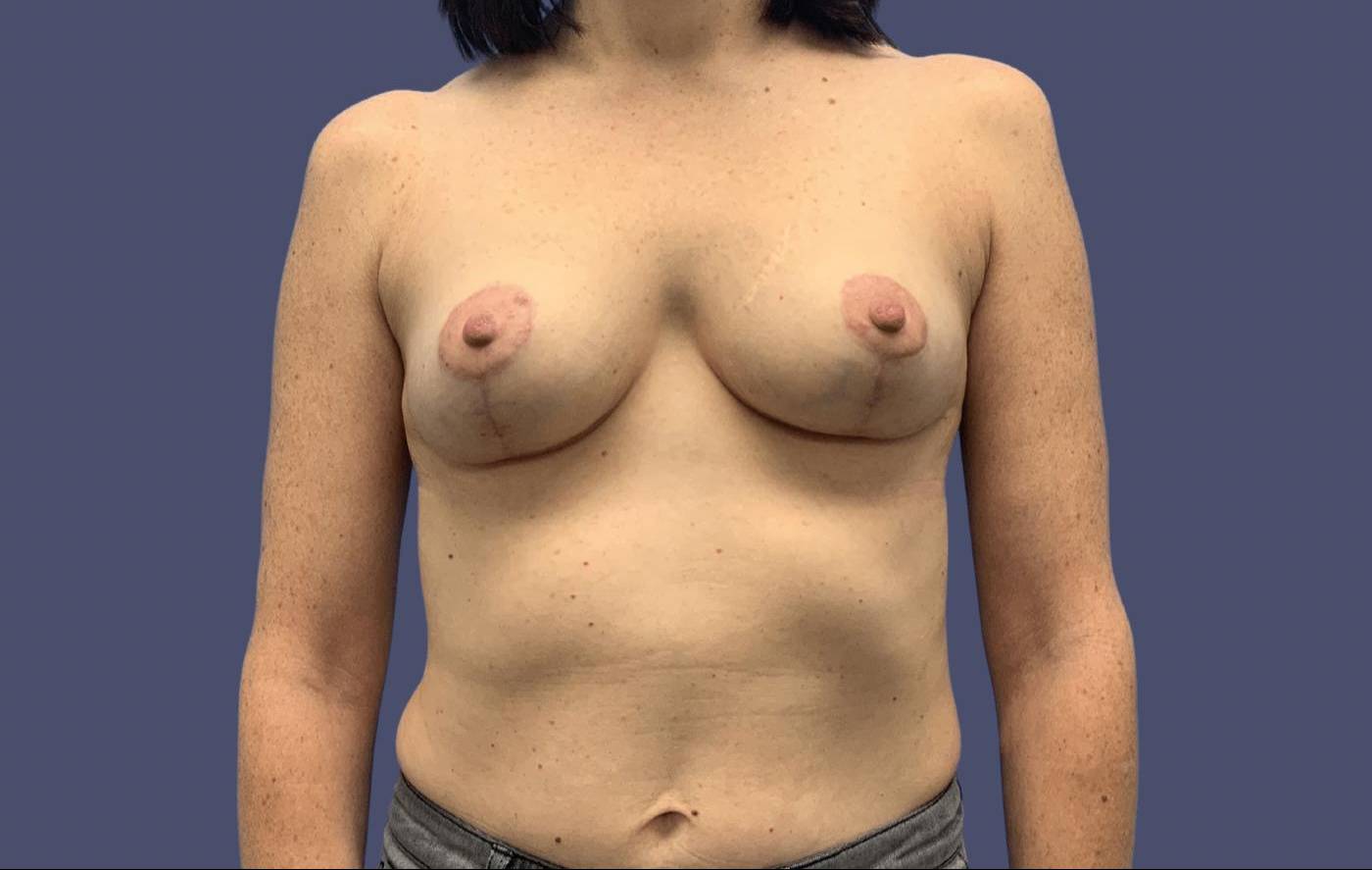 Breast Reduction 10 After