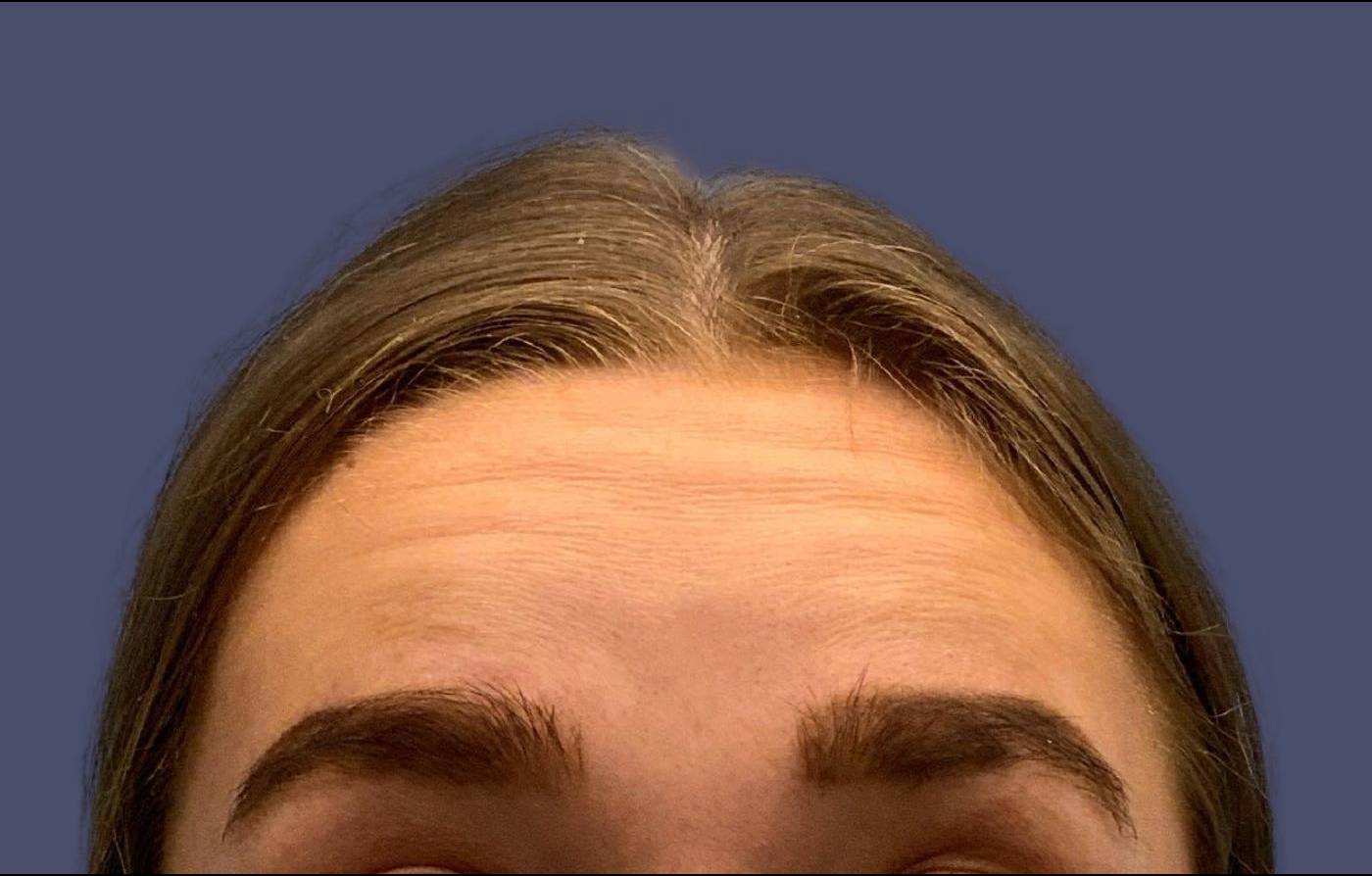 Tox 8 - Botox Before