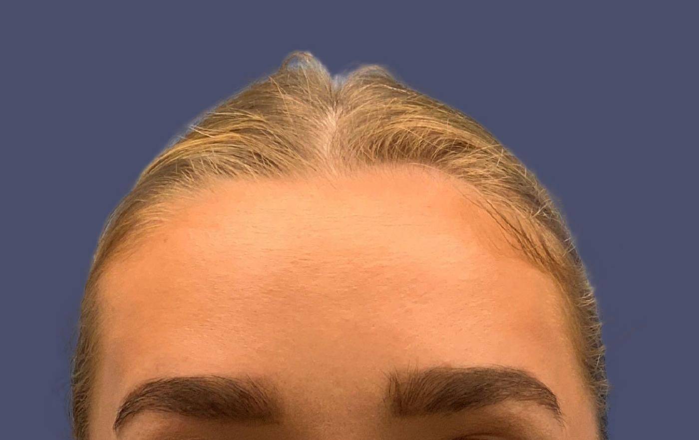 Tox 8 - Botox After