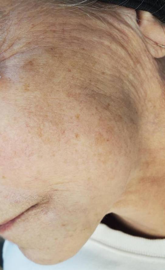 Skin Resurfacing 2 - HALO Before