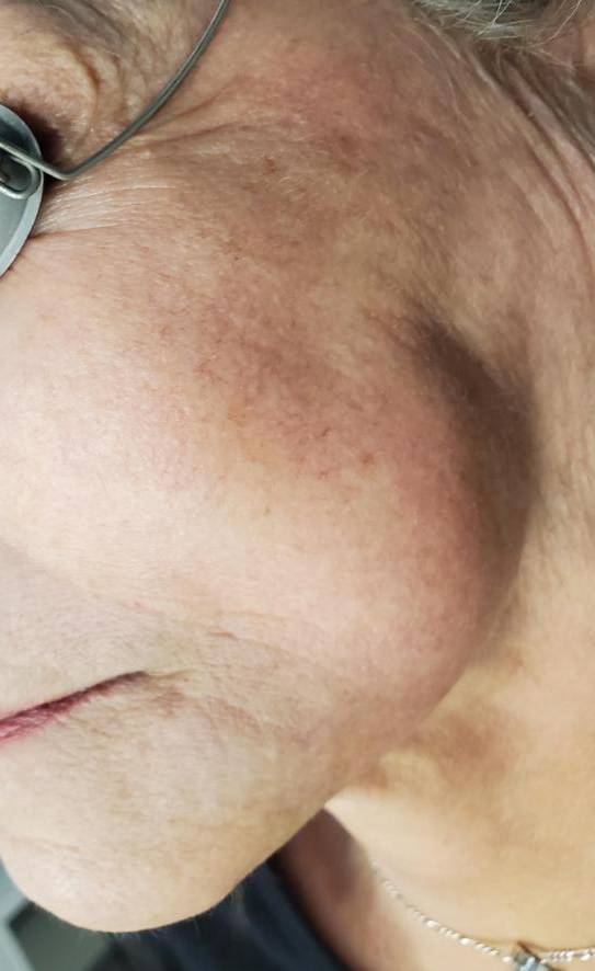 Skin Resurfacing 2 - HALO After