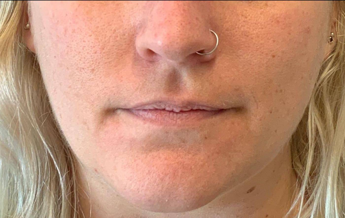 Lip Filler 14 Before