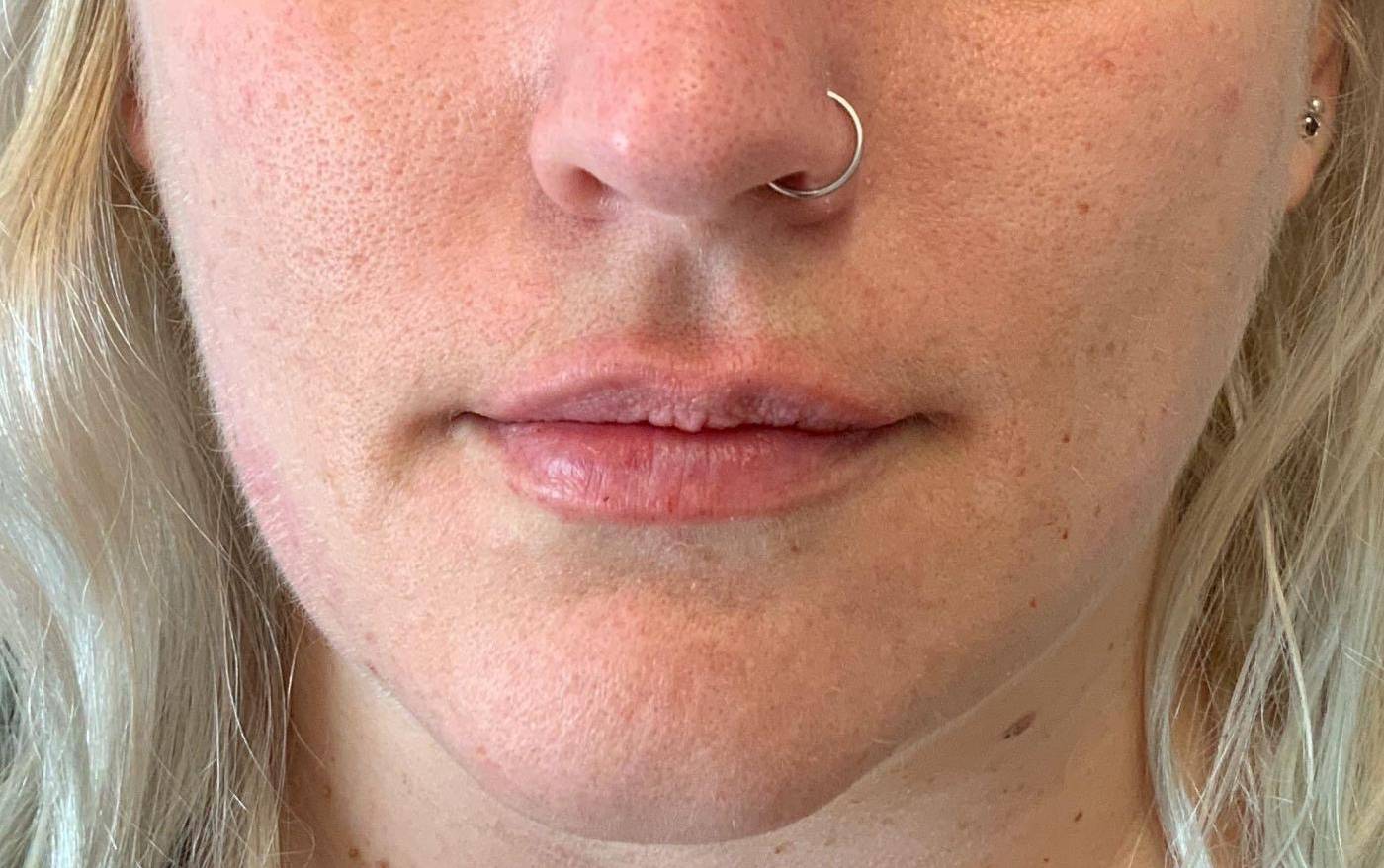 Lip Filler 14 After