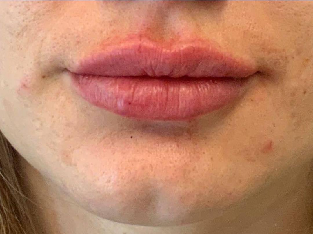 Lip Filler 8 After