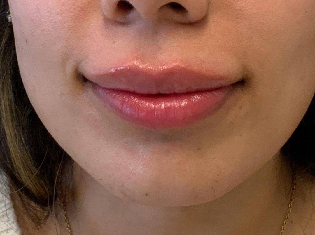 Lip Filler 5 After