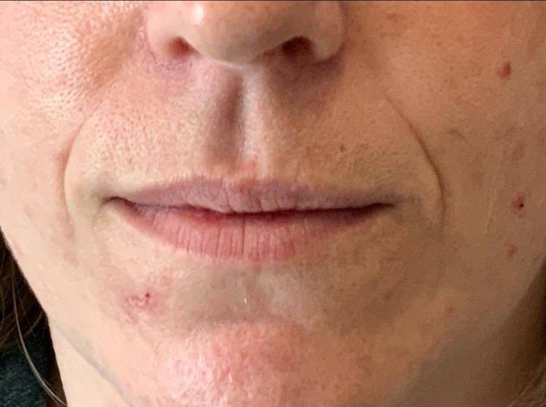 Dermal Filler 5 - Nasolabial Folds Before