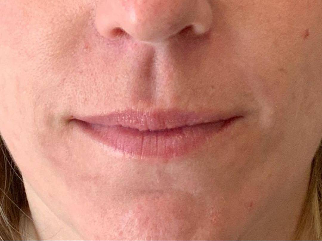 Dermal Filler 5 - Nasolabial Folds After