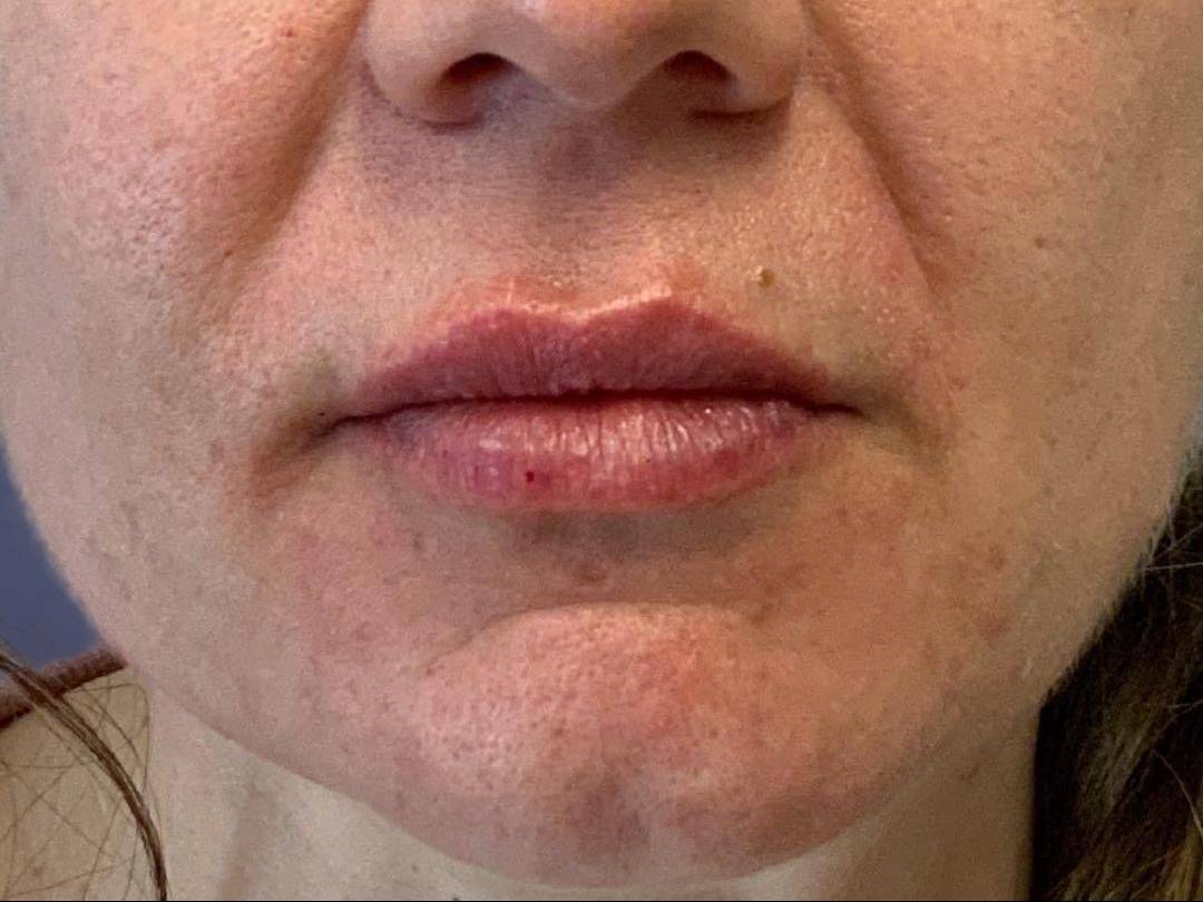 Lip Filler 17 After