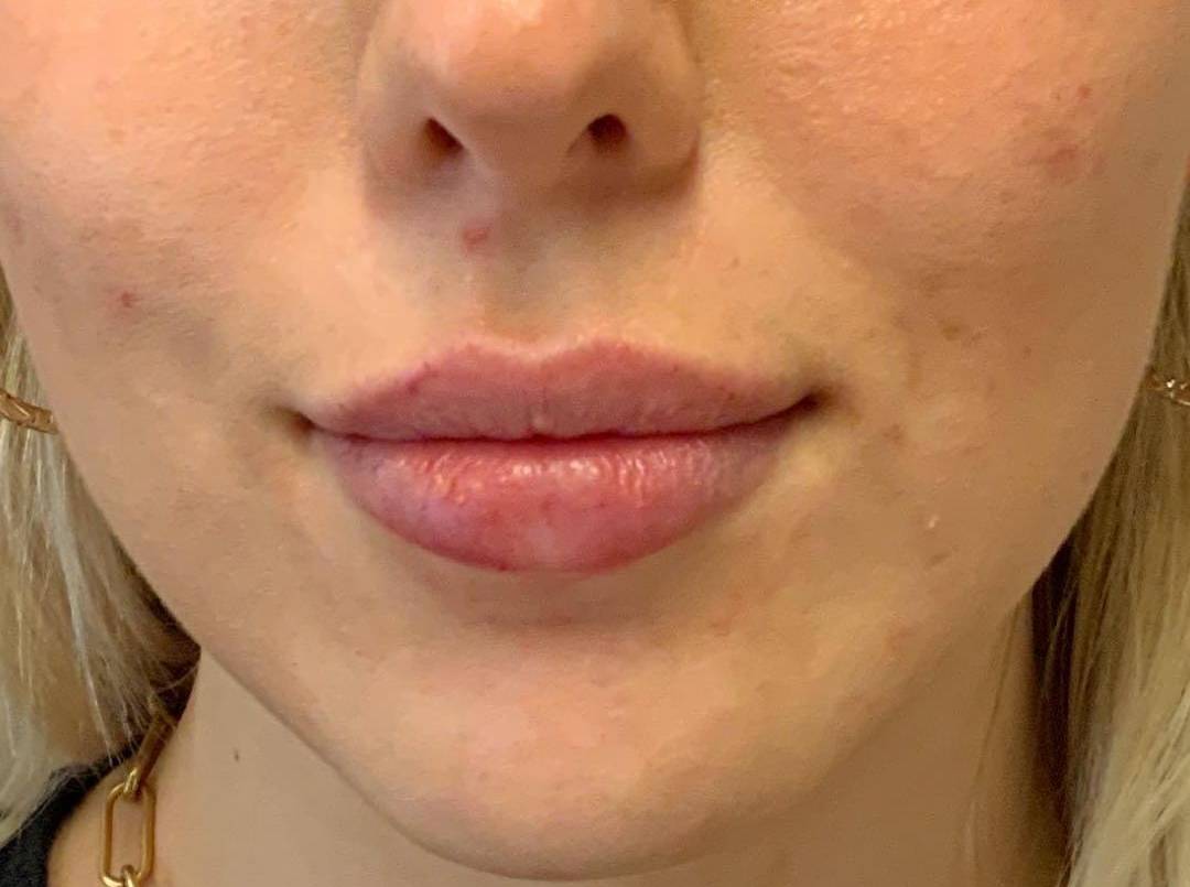 Lip Filler 4 After