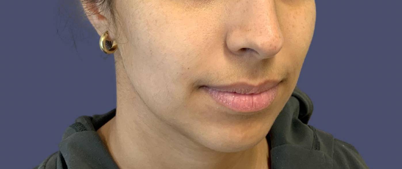 Dermal Filler 1 - Chin and Jawline Before