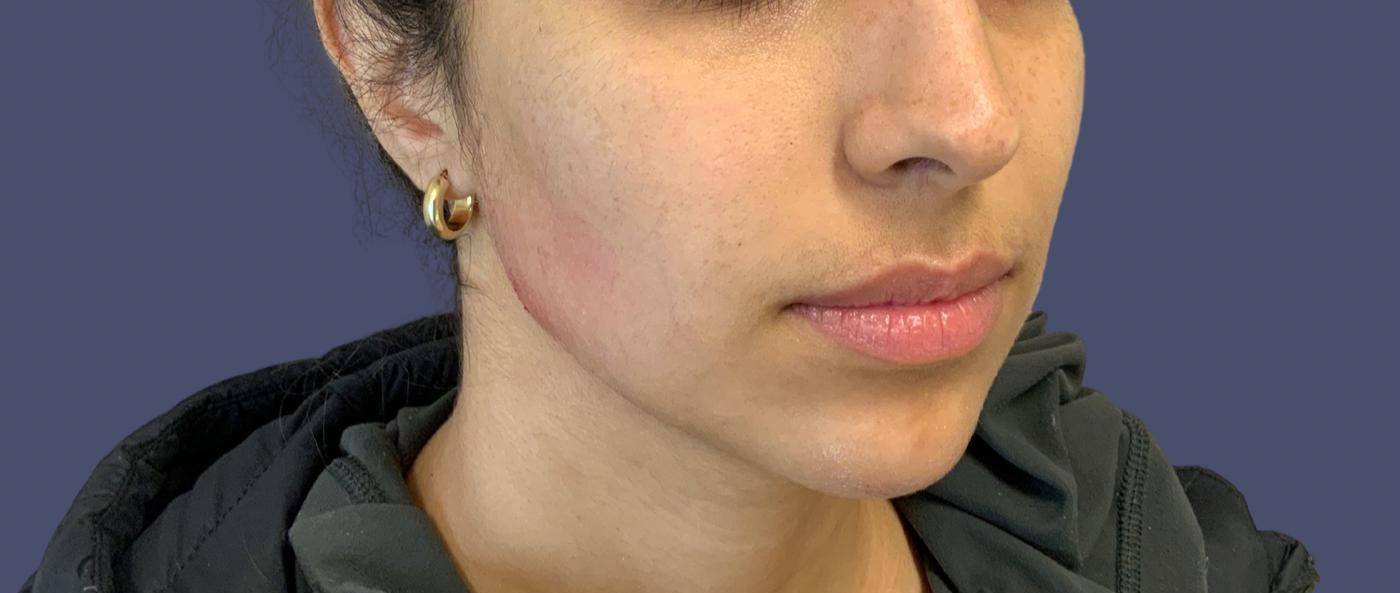 Dermal Filler 1 - Chin and Jawline After