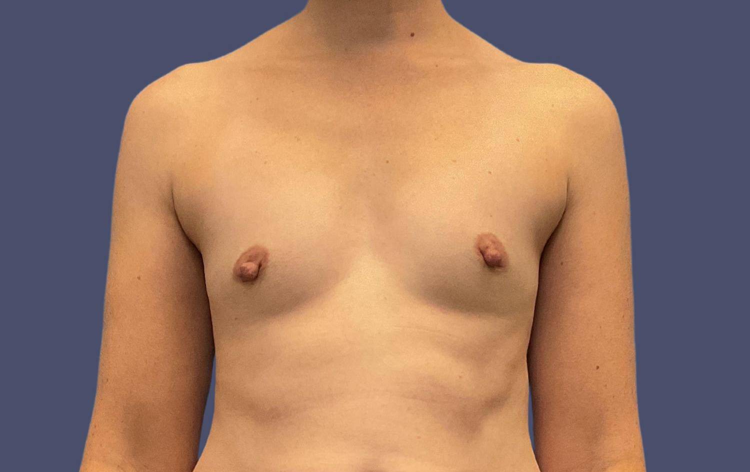 Breast Augmentation 45 Before
