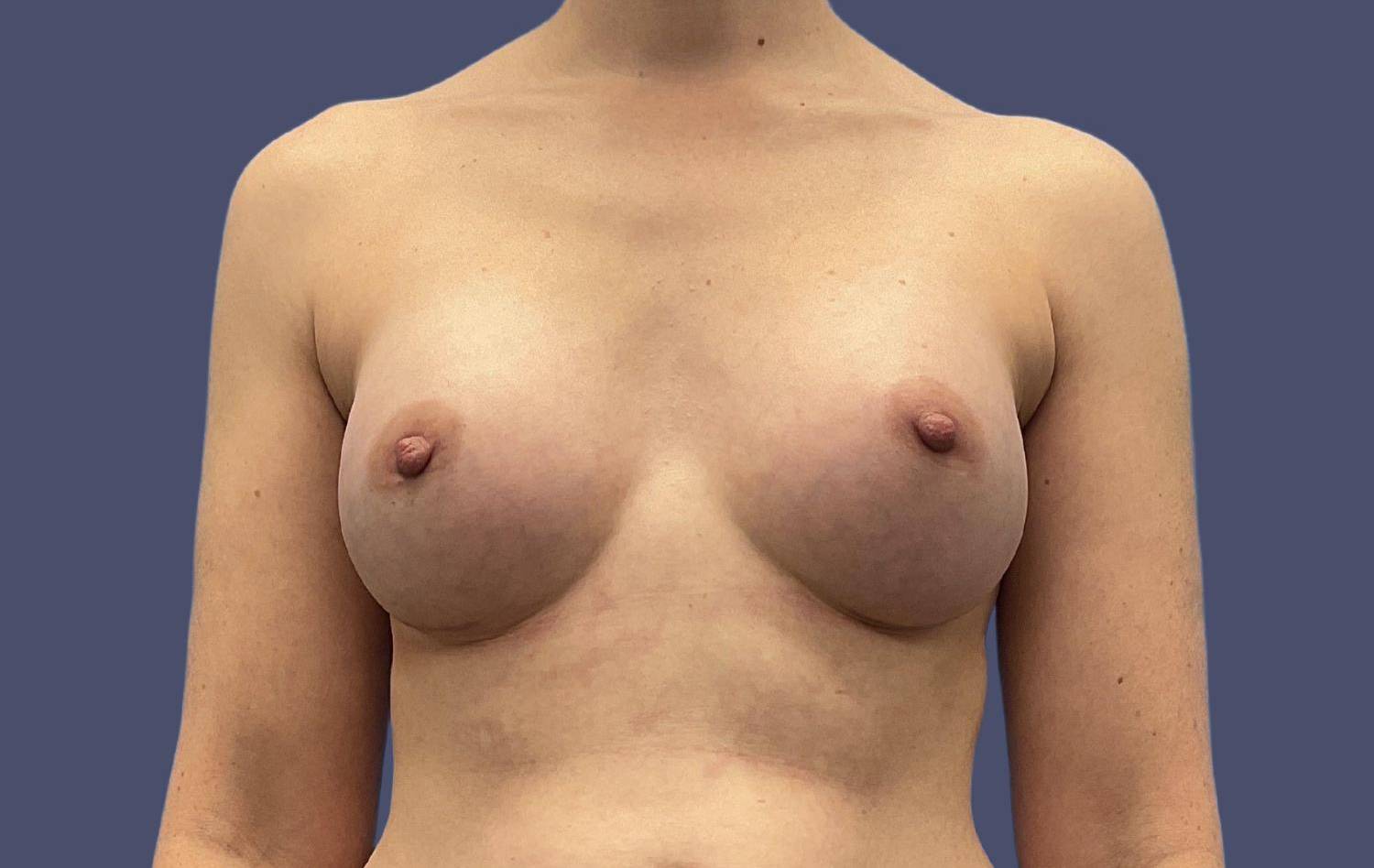 Breast Augmentation 45 After