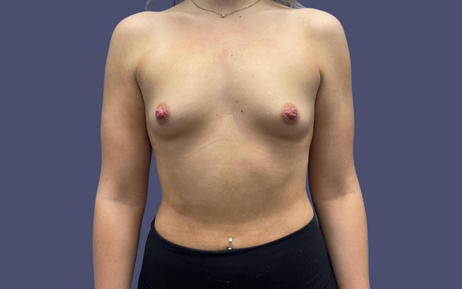 Breast Augmentation 46 Before