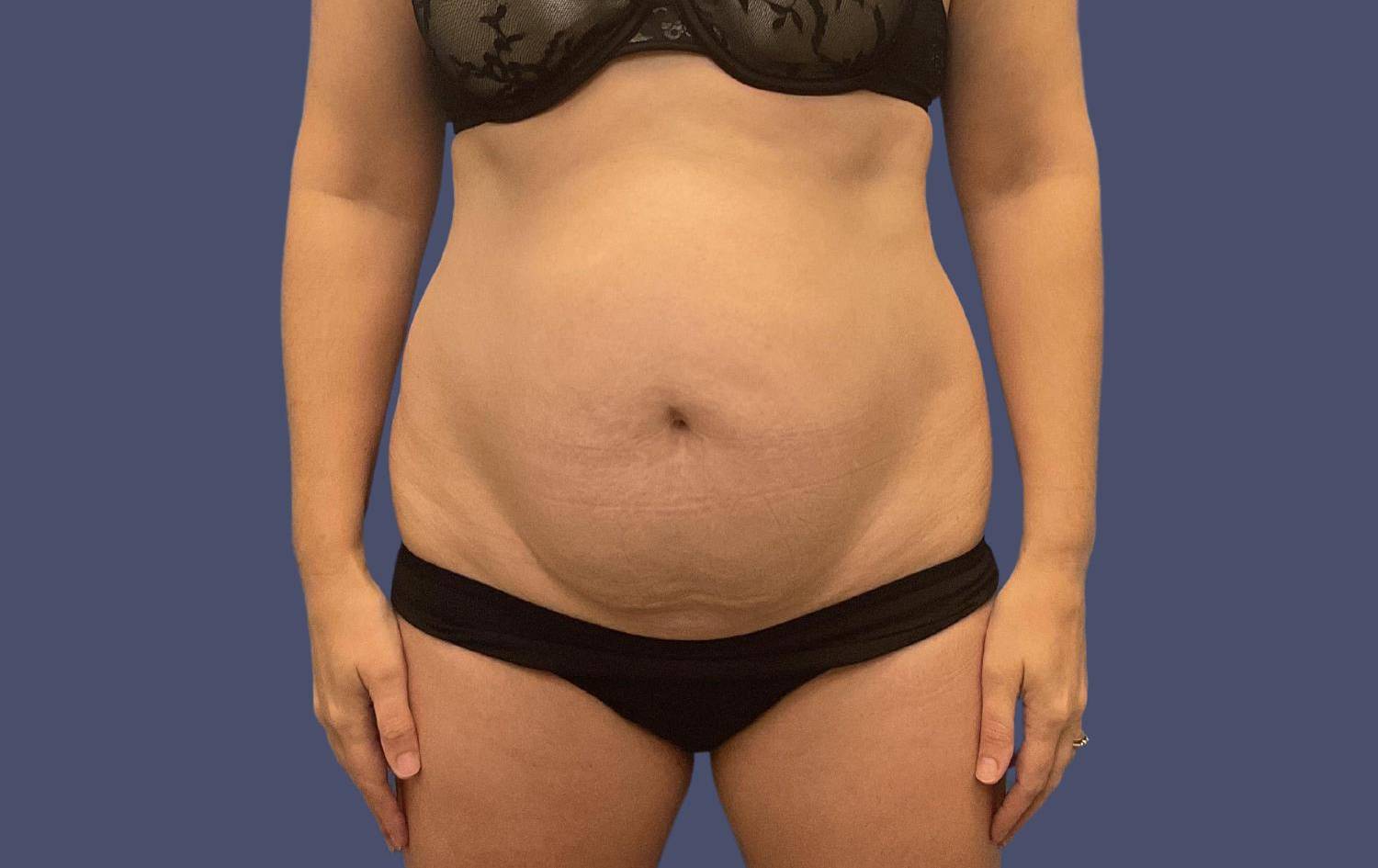 Abdominoplasty (Tummy Tuck) 23 Before