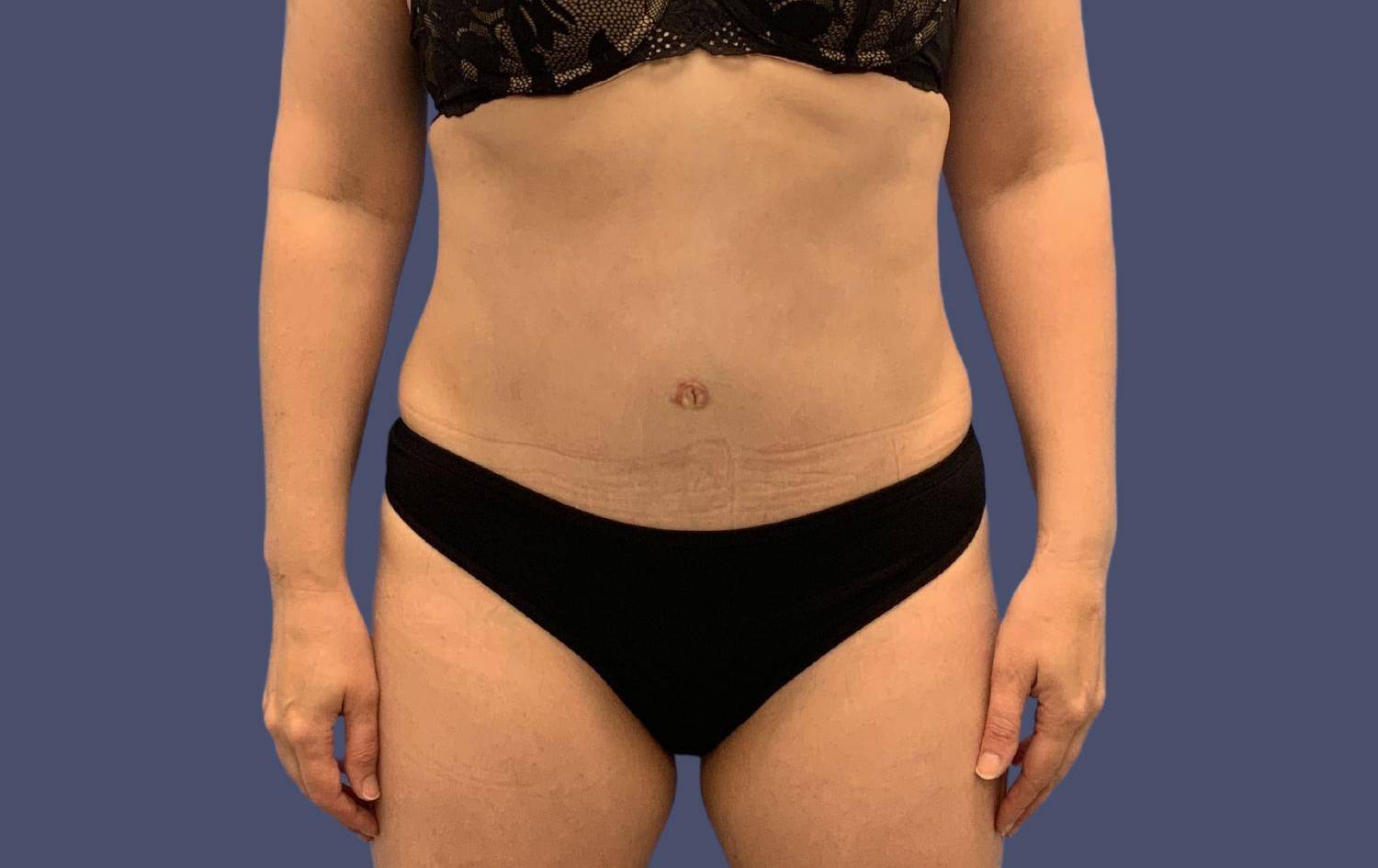 Abdominoplasty (Tummy Tuck) 21 After