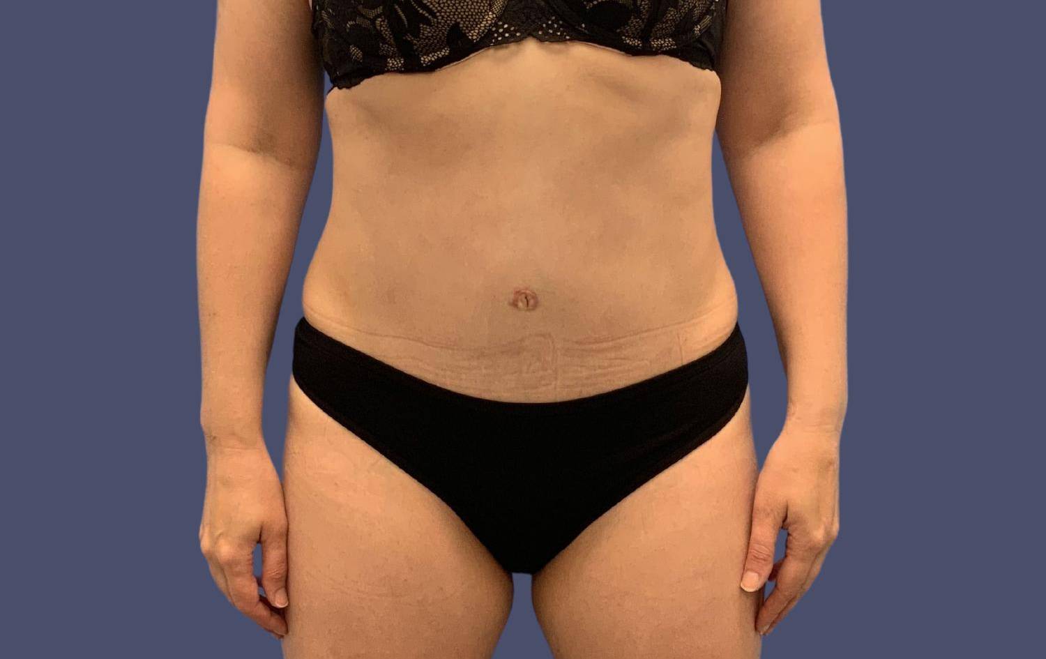 Abdominoplasty (Tummy Tuck) 23 After