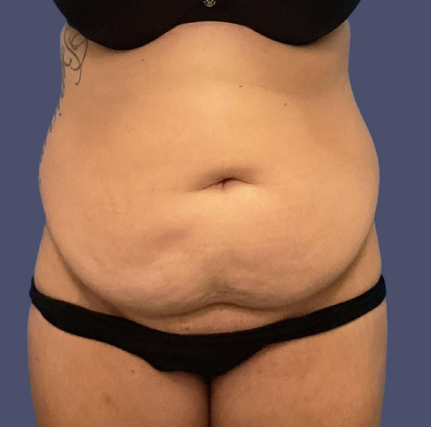Abdominoplasty (Tummy Tuck) 9 Before