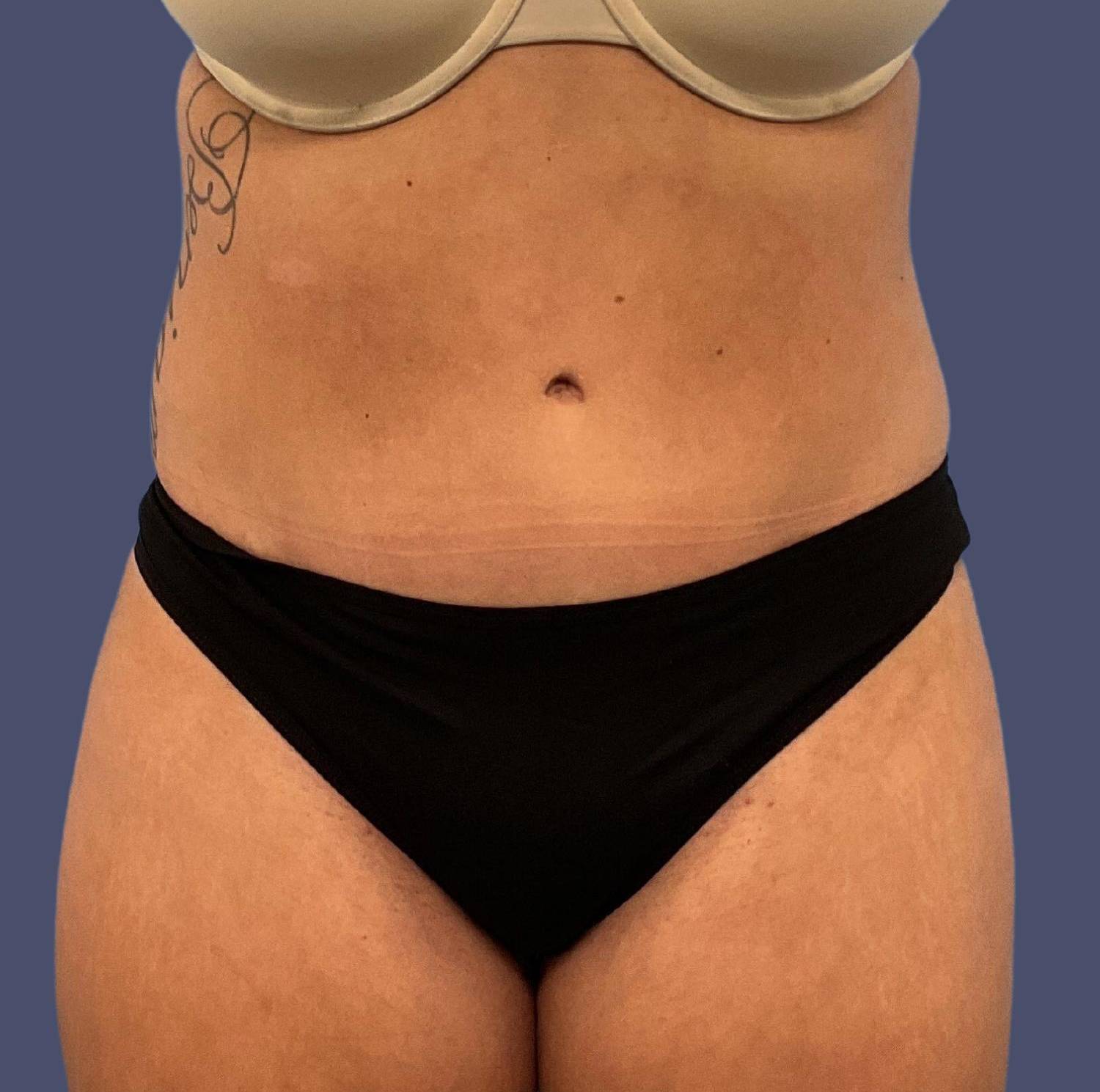 Abdominoplasty (Tummy Tuck) 10 After