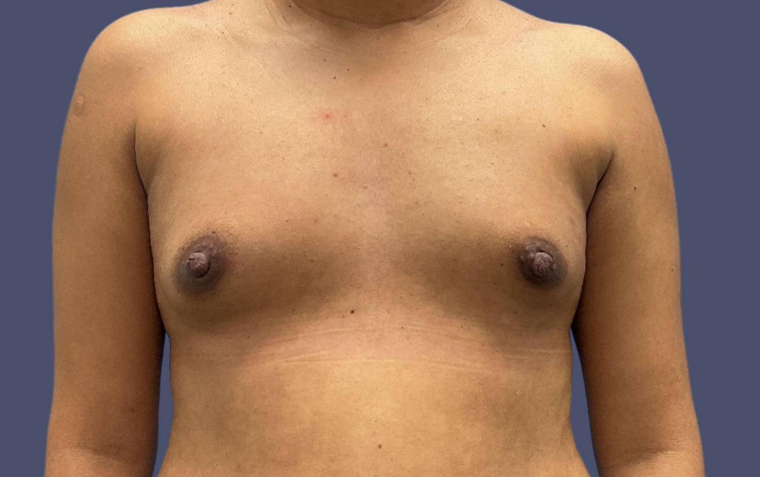 Breast Augmentation 47 Before