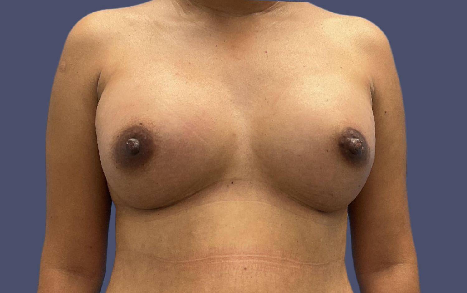 Breast Augmentation 38 After