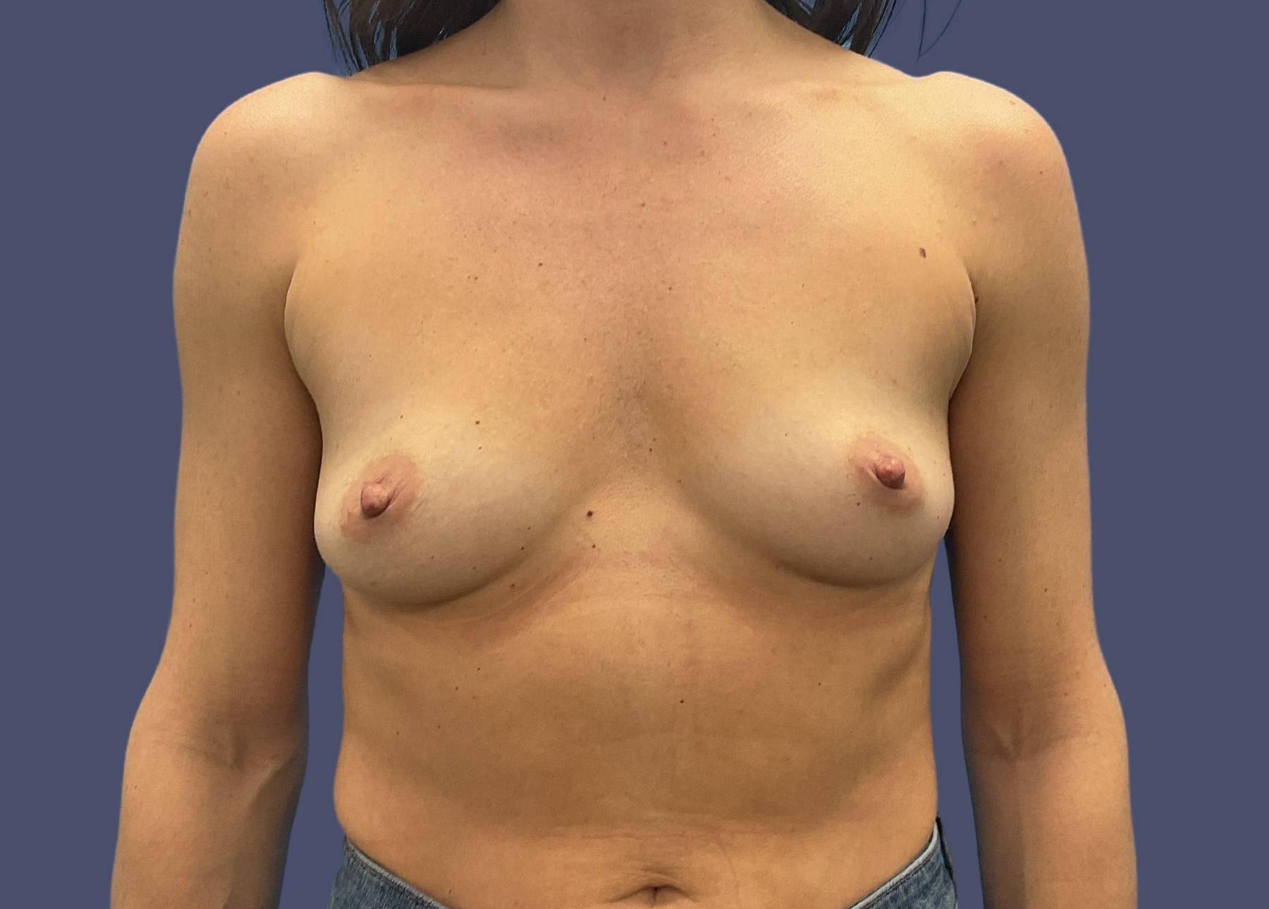 Breast Augmentation 48 Before