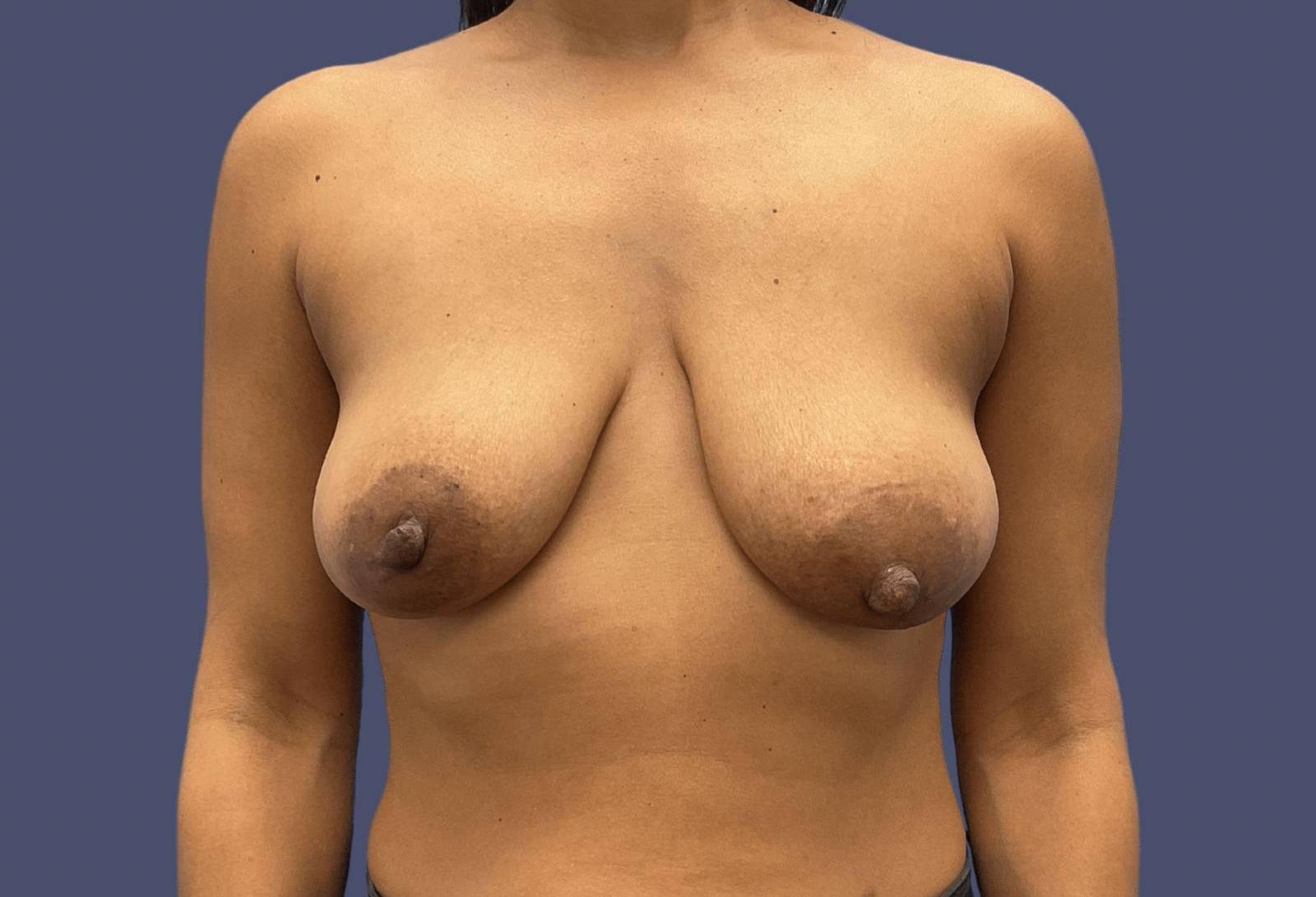 Breast Lift w/Augmentation 9 Before