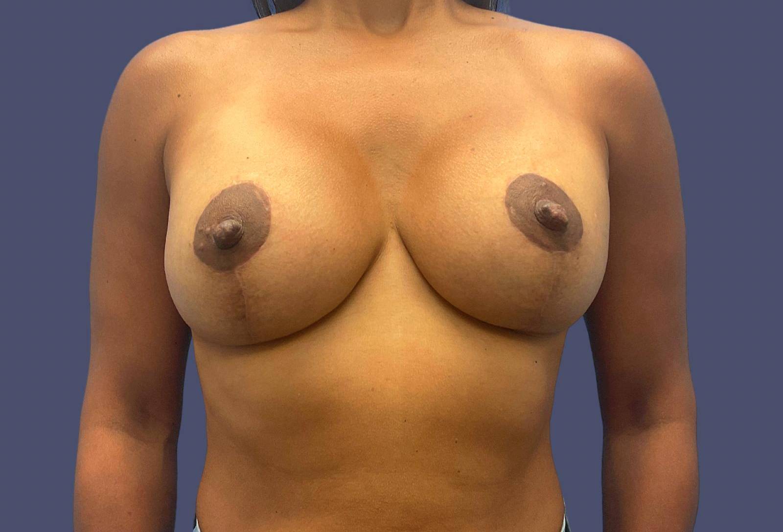 Breast Lift w/Augmentation 9 After