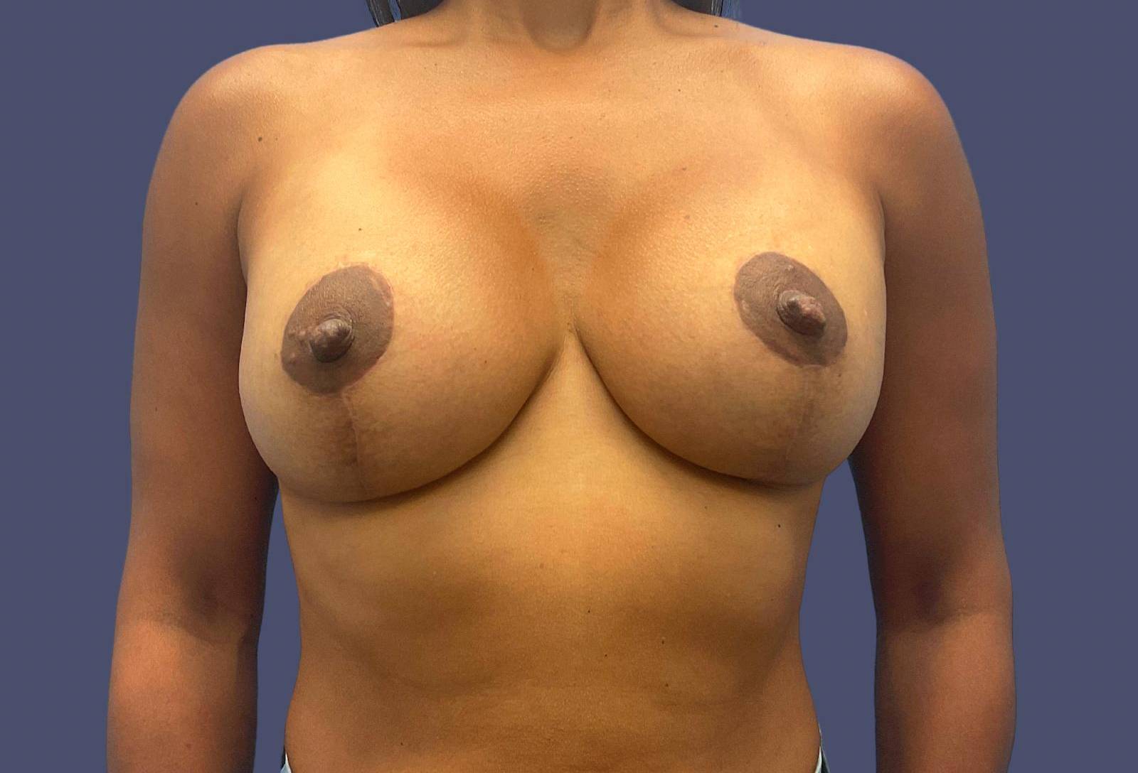 Breast Lift w/Augmentation 11 After