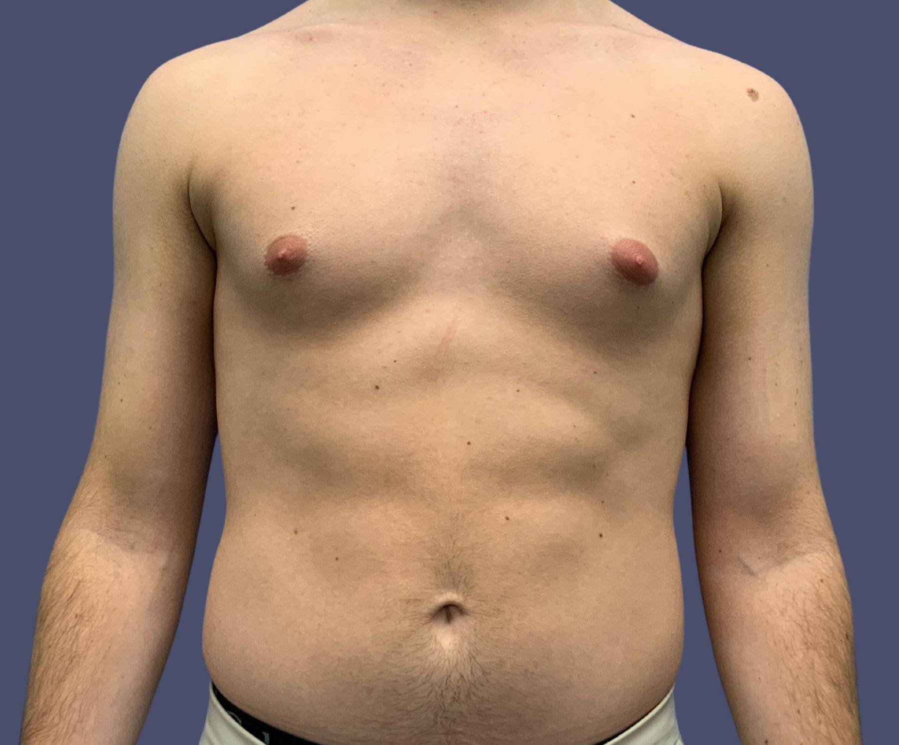 Gynecomastia 3 Before