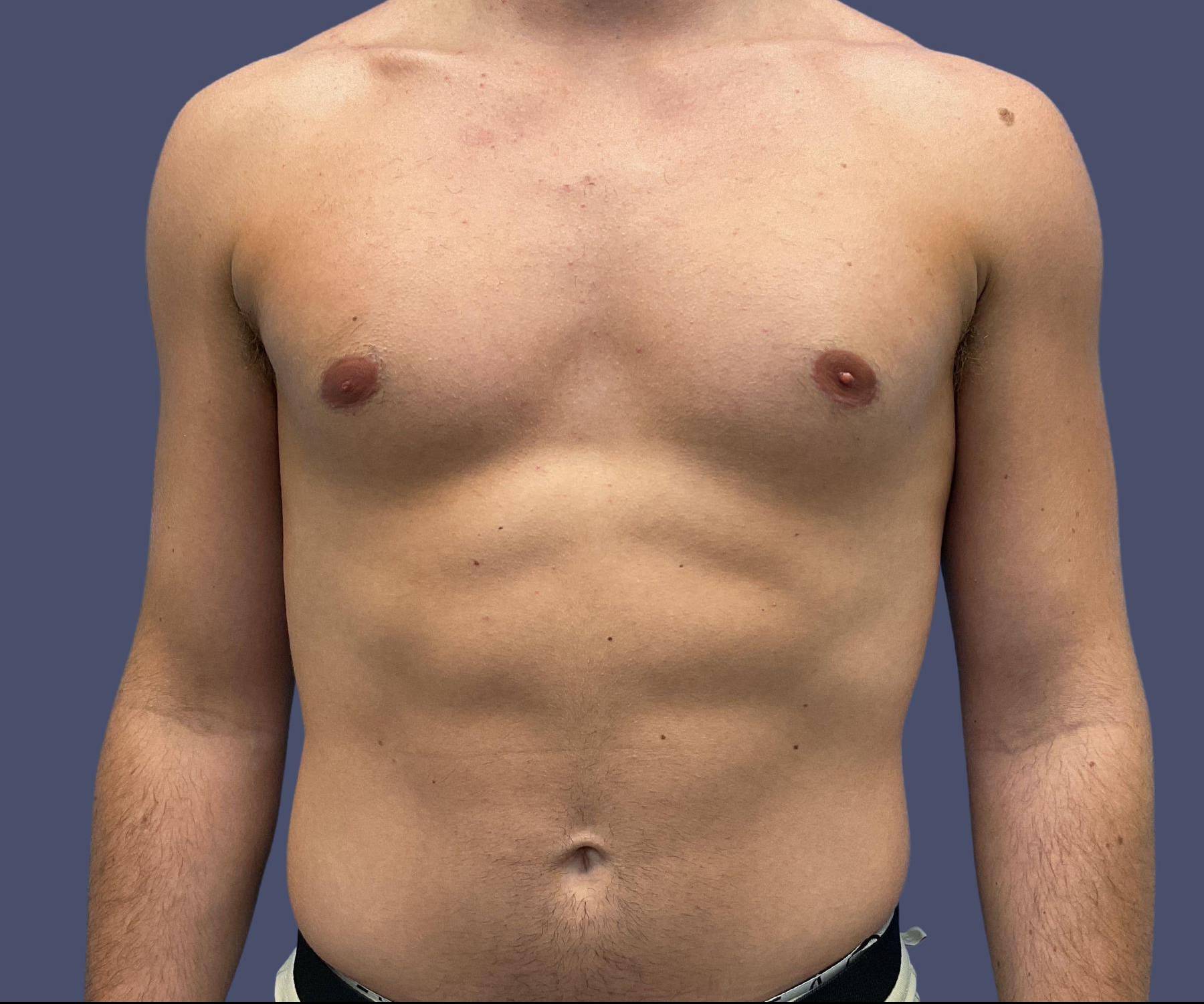 Gynecomastia 3 After