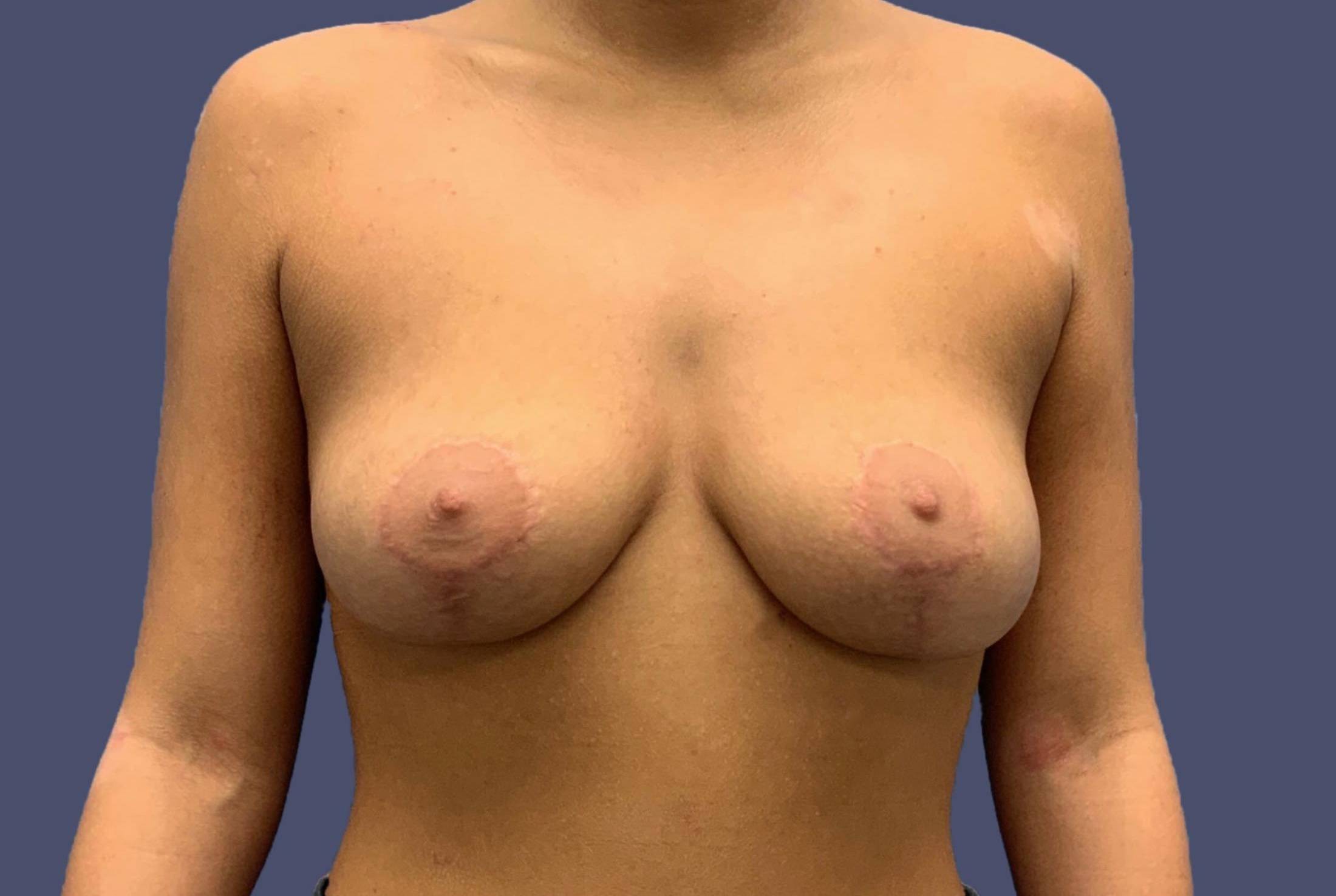 Breast Lift 1 After