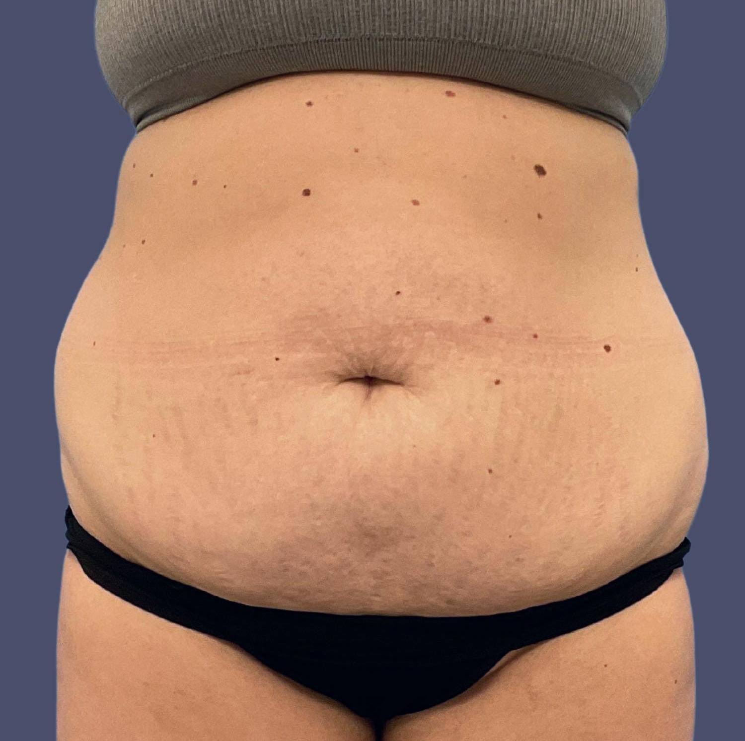 Abdominoplasty (Tummy Tuck) 12 Before