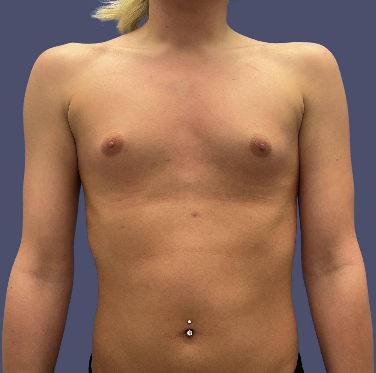 Breast Augmentation 40 Before