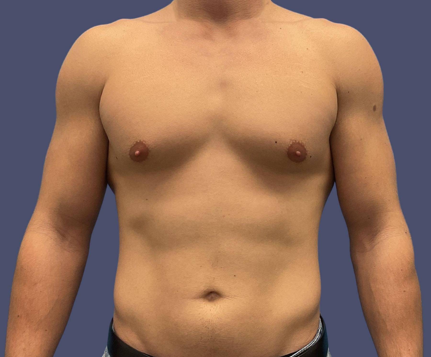 Gynecomastia 4 Before