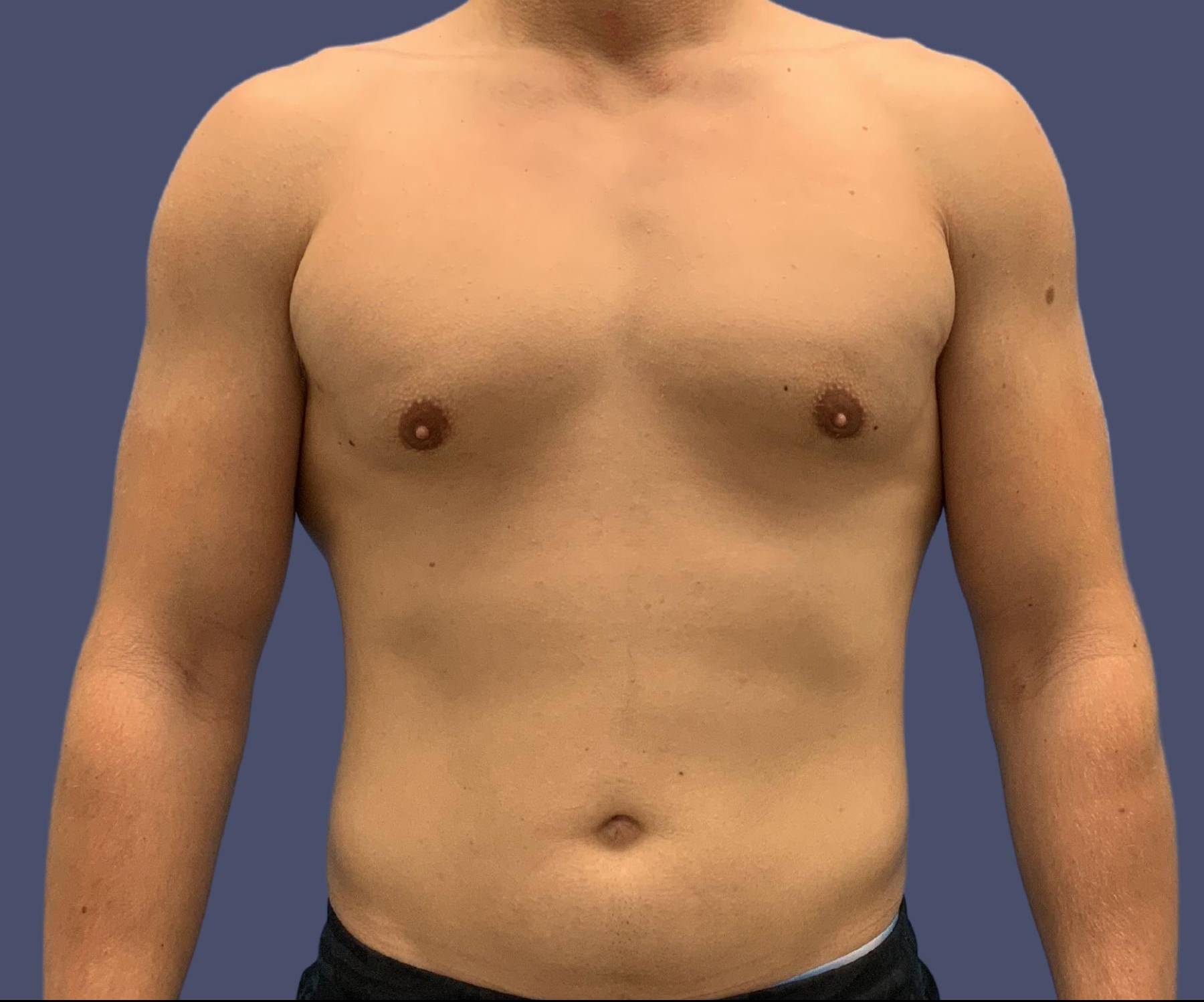 Gynecomastia 4 After