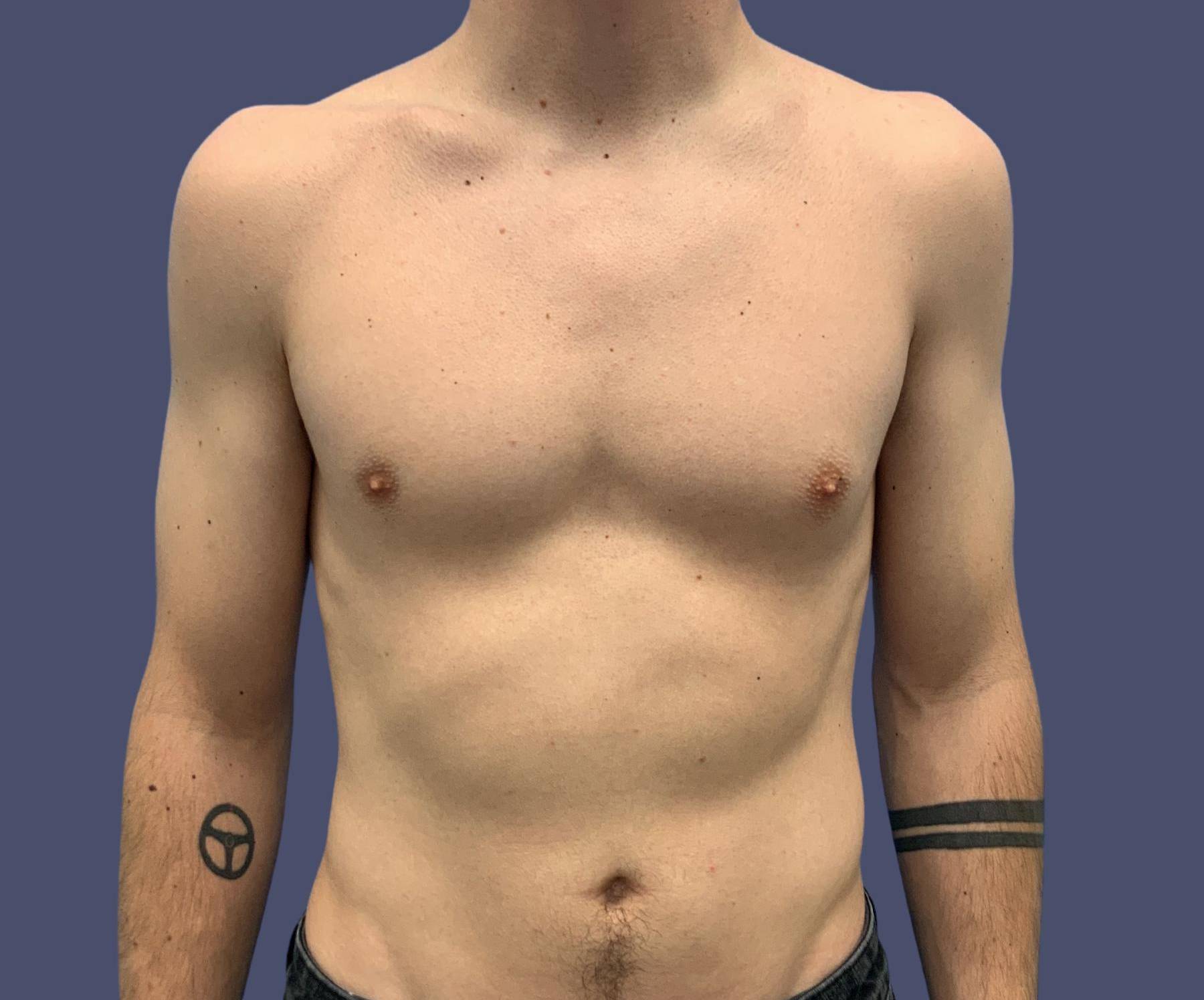 Gynecomastia 5 Before