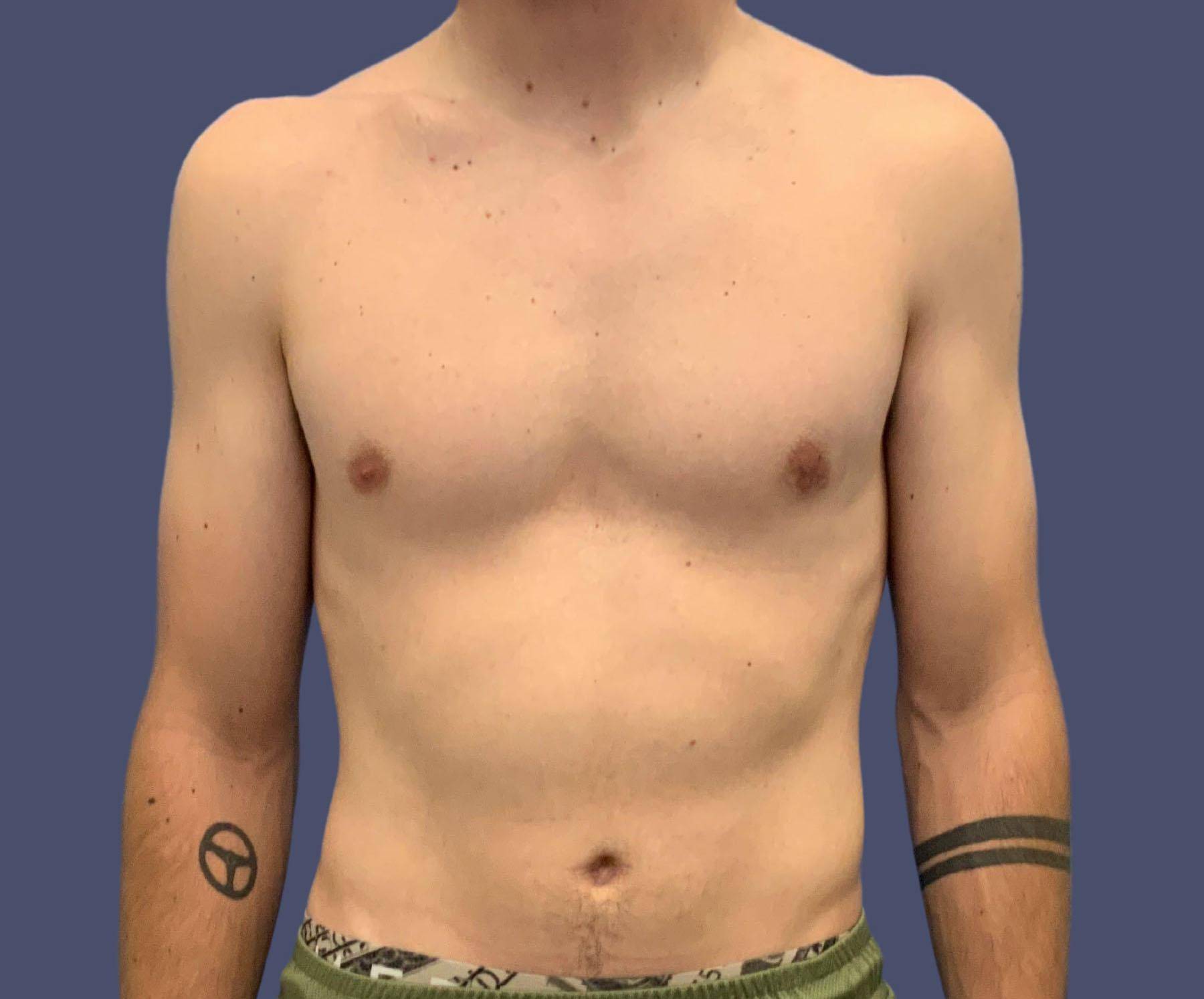 Gynecomastia 5 After