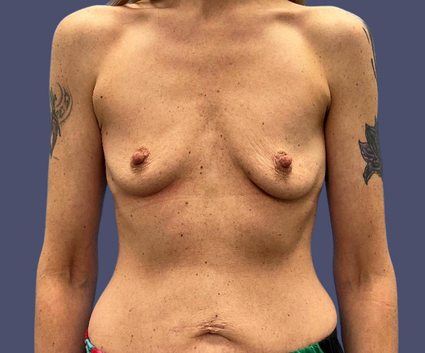 Breast Augmentation 33 Before